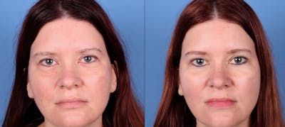 Eyelid Surgery (Upper & Lower Blepharoplasty) Before & After Gallery - Patient 277569 - Image 1