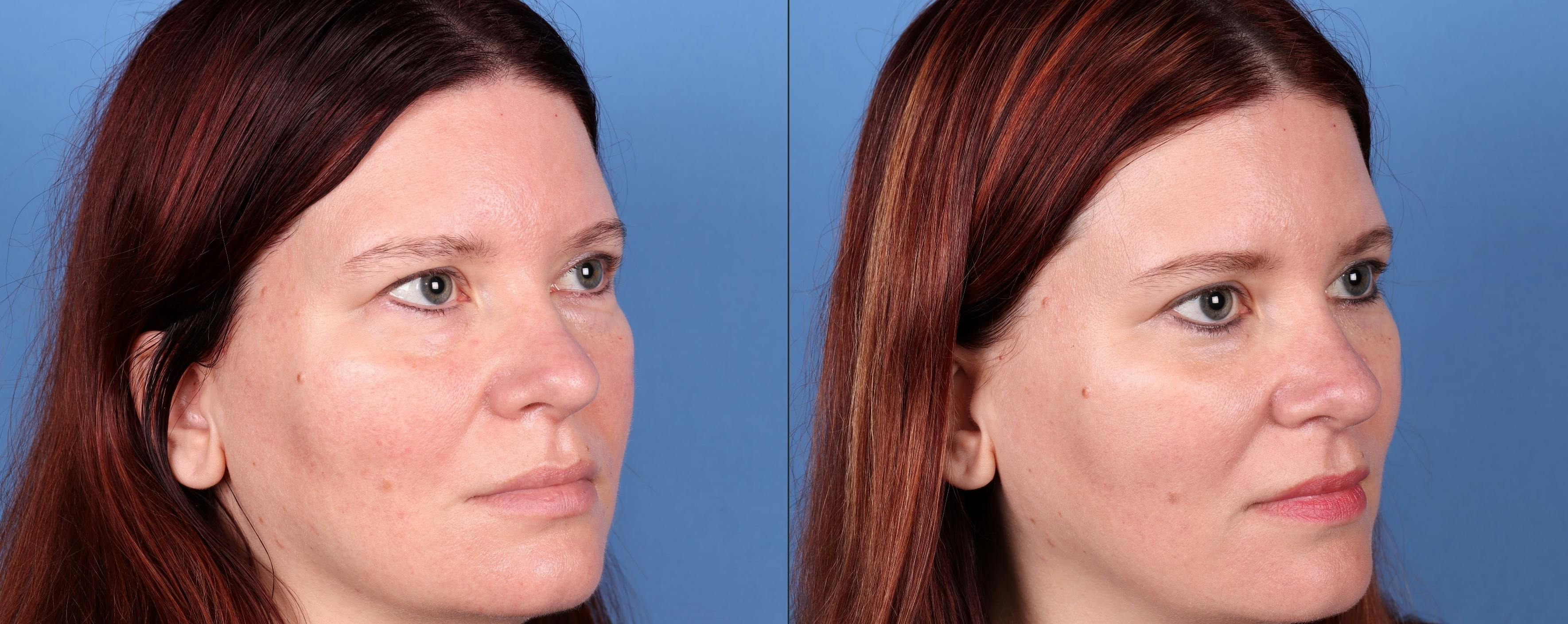 Eyelid Surgery (Upper & Lower Blepharoplasty) Before & After Gallery - Patient 277569 - Image 2