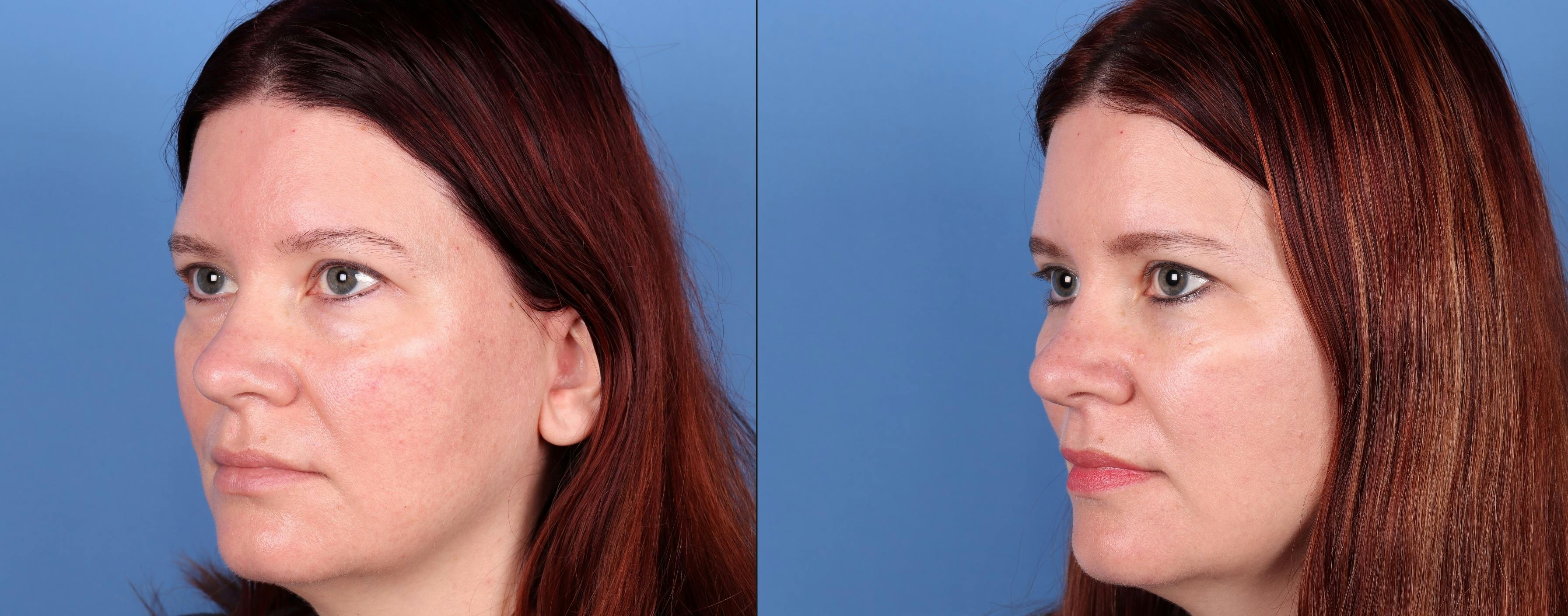 Eyelid Surgery (Blepharoplasty) Before & After Gallery - Patient 148430506 - Image 3