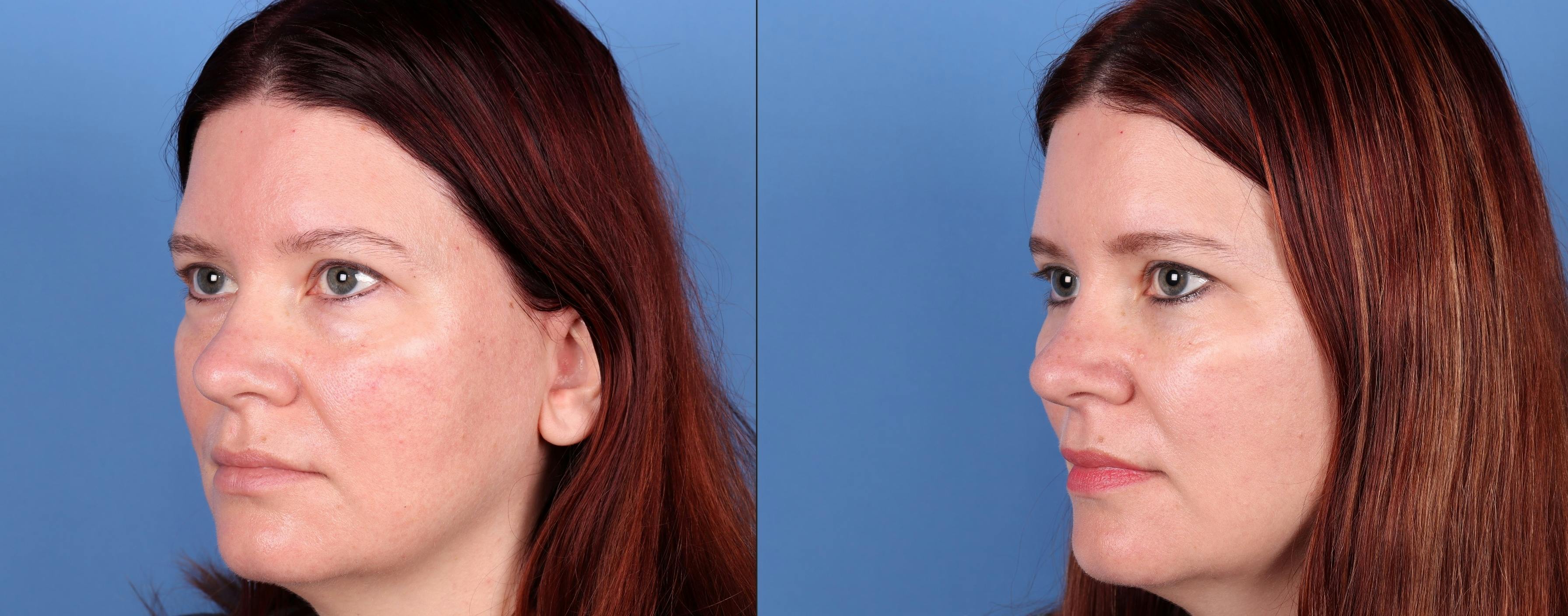Eyelid Surgery (Upper & Lower Blepharoplasty) Before & After Gallery - Patient 277569 - Image 3