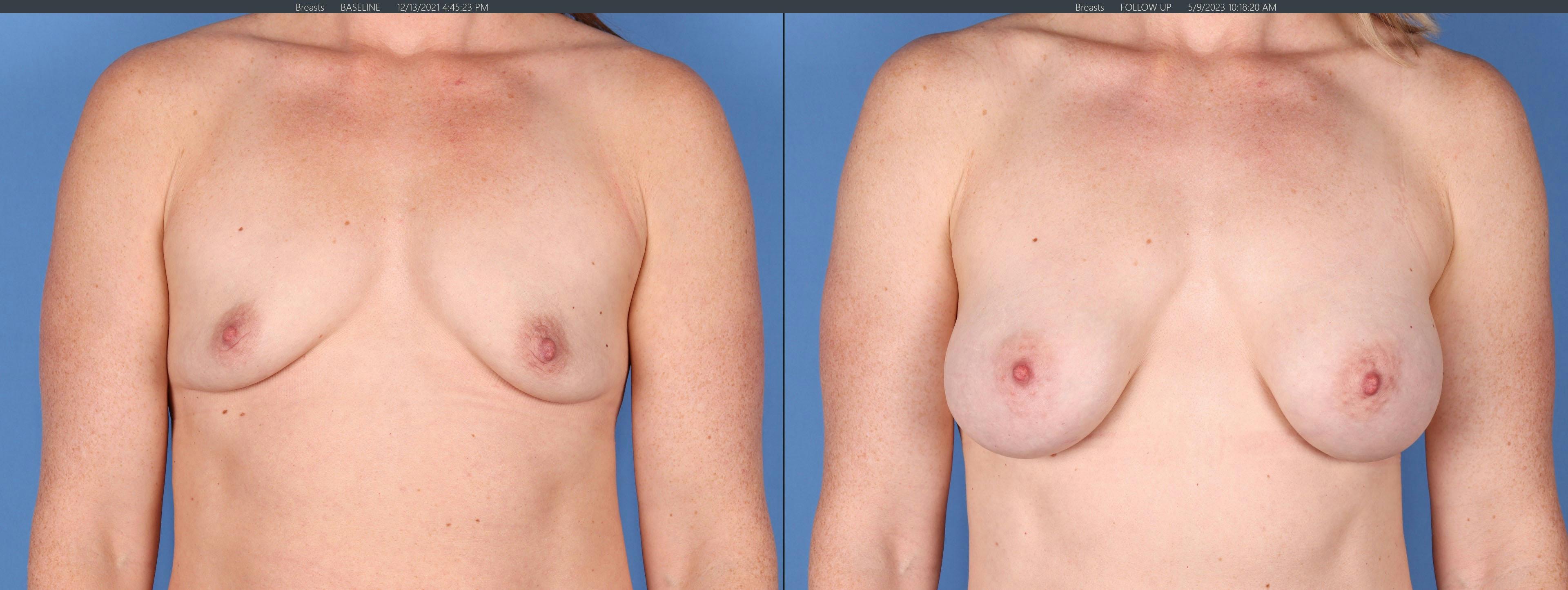 Breast Augmentation Before & After Gallery - Patient 148447958 - Image 1