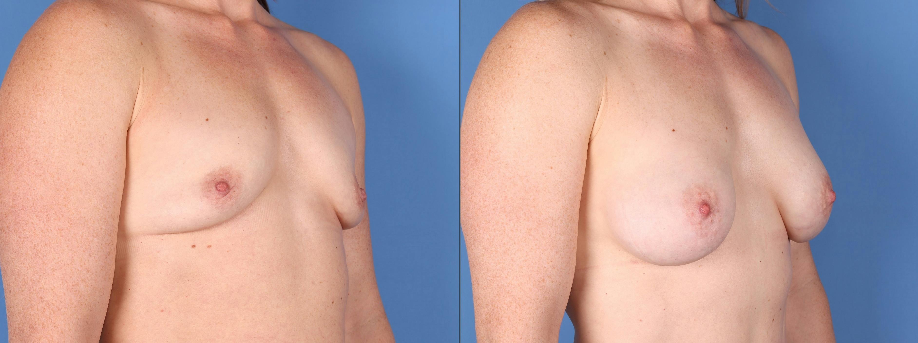 Breast Augmentation Before & After Gallery - Patient 148447958 - Image 2