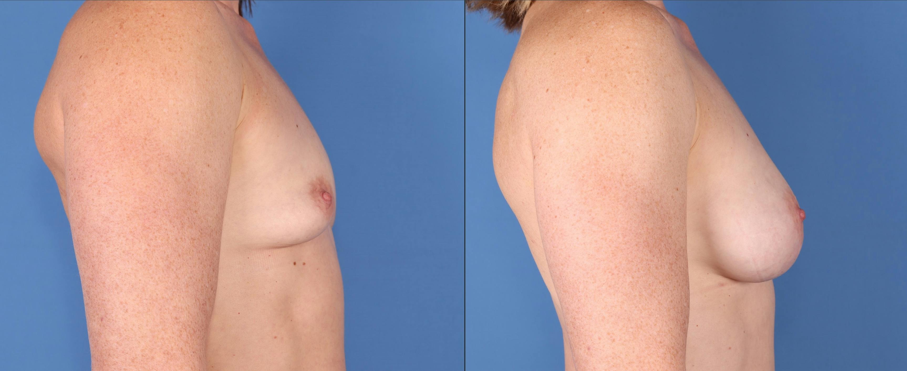Breast Augmentation Before & After Gallery - Patient 148447958 - Image 3