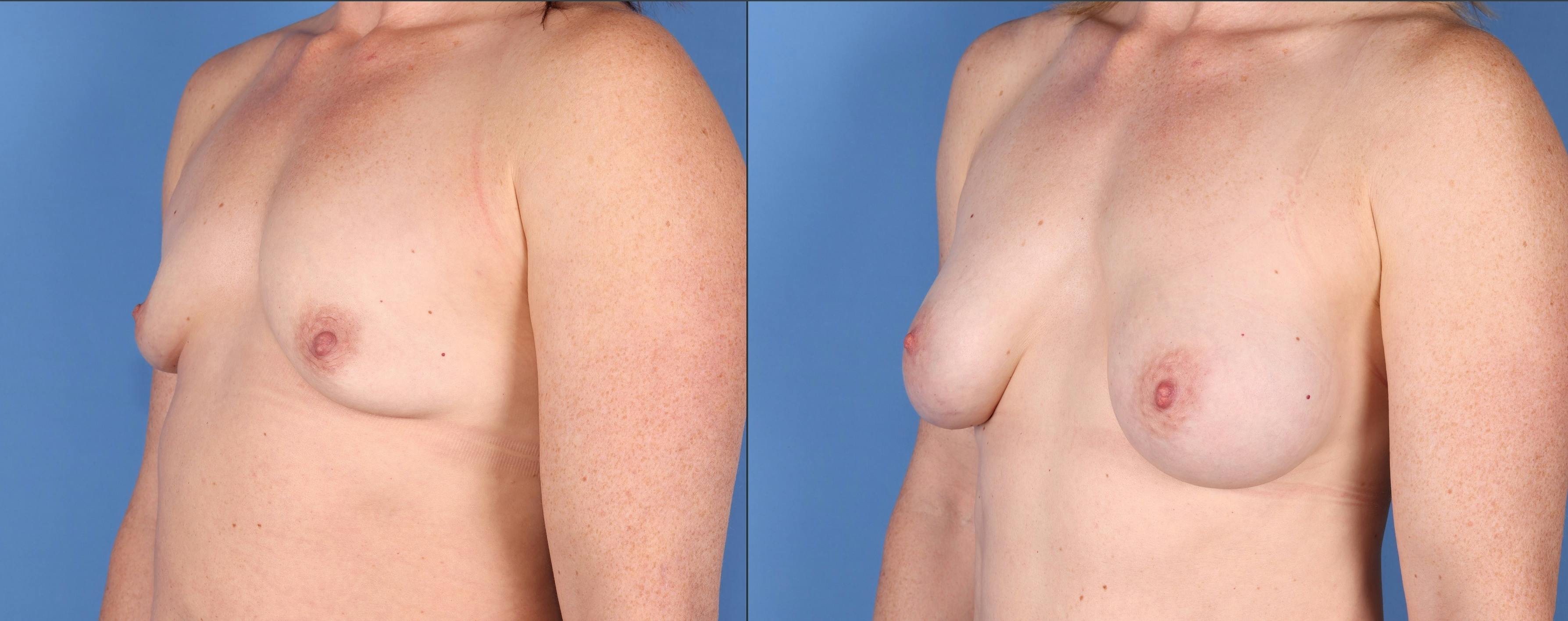 Breast Augmentation Before & After Gallery - Patient 148447958 - Image 4