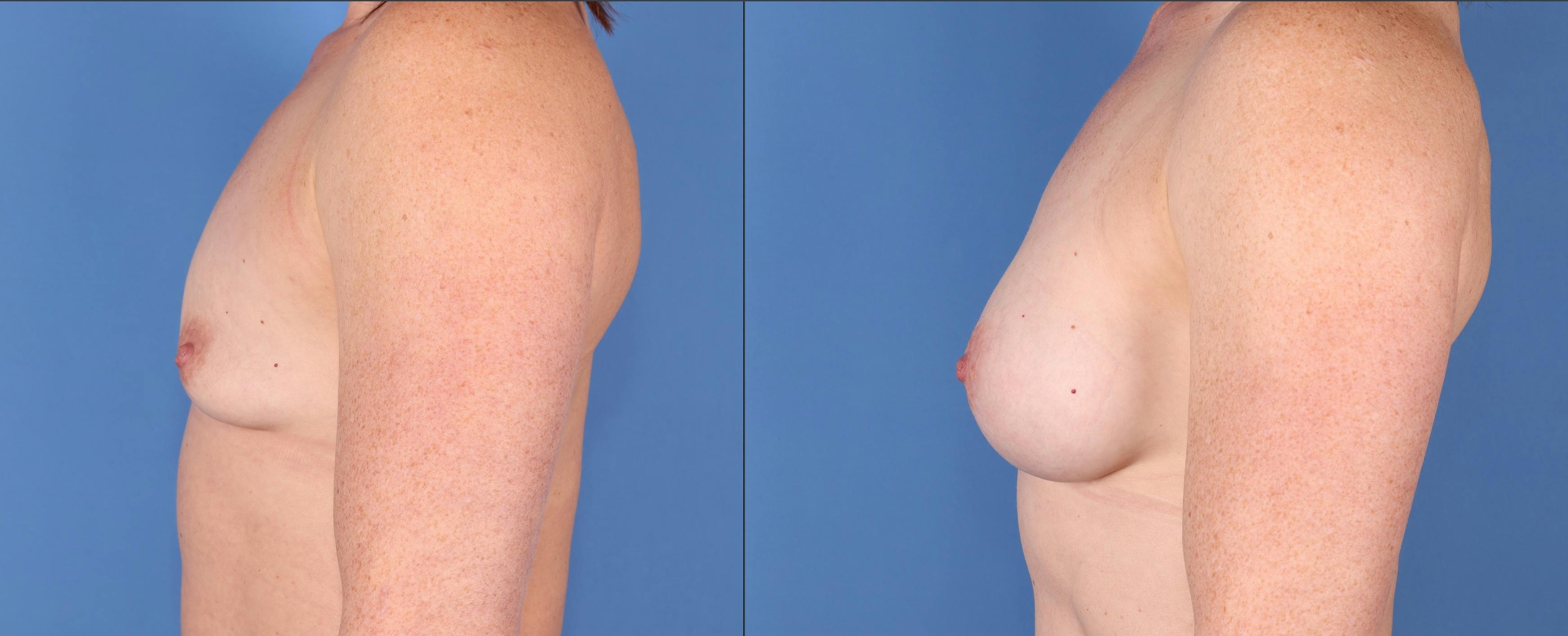 Breast Augmentation Before & After Gallery - Patient 148447958 - Image 5
