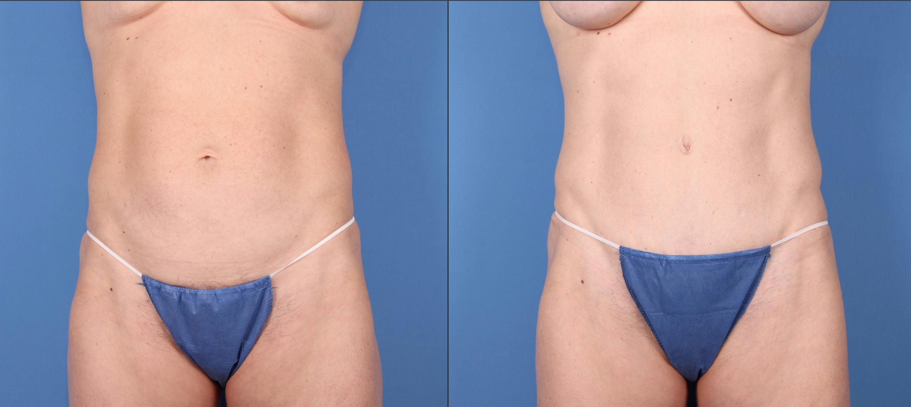 Liposuction