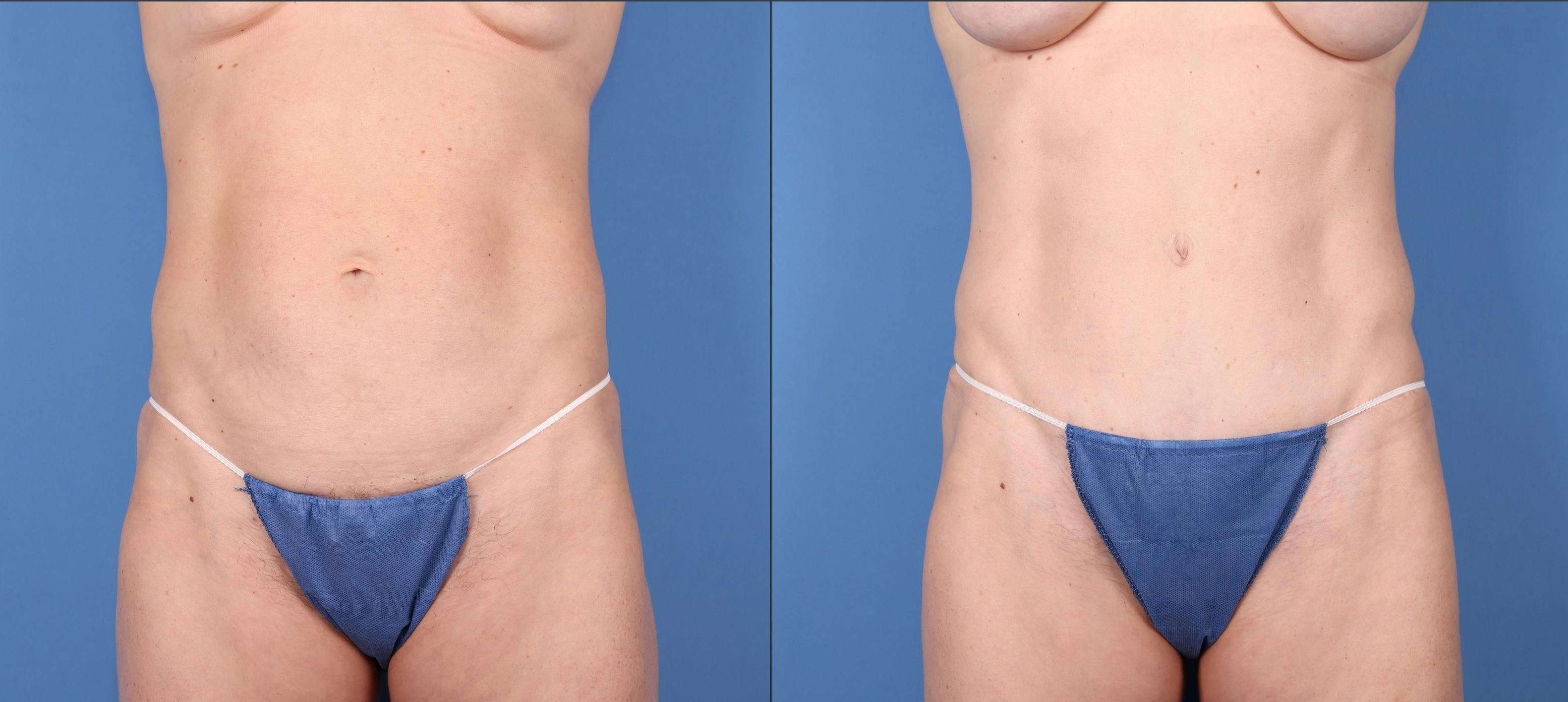 Tummy Tuck Before & After Gallery - Patient 148447969 - Image 1