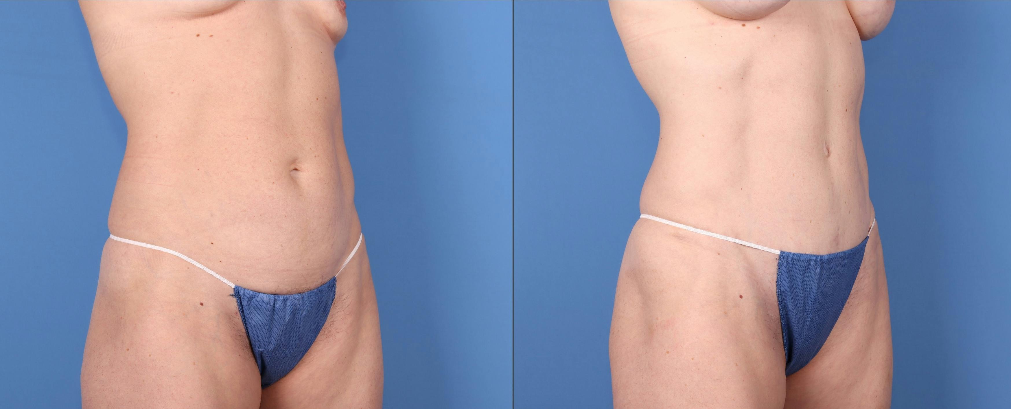 Abdomen Before & After Gallery - Patient 149385204 - Image 2