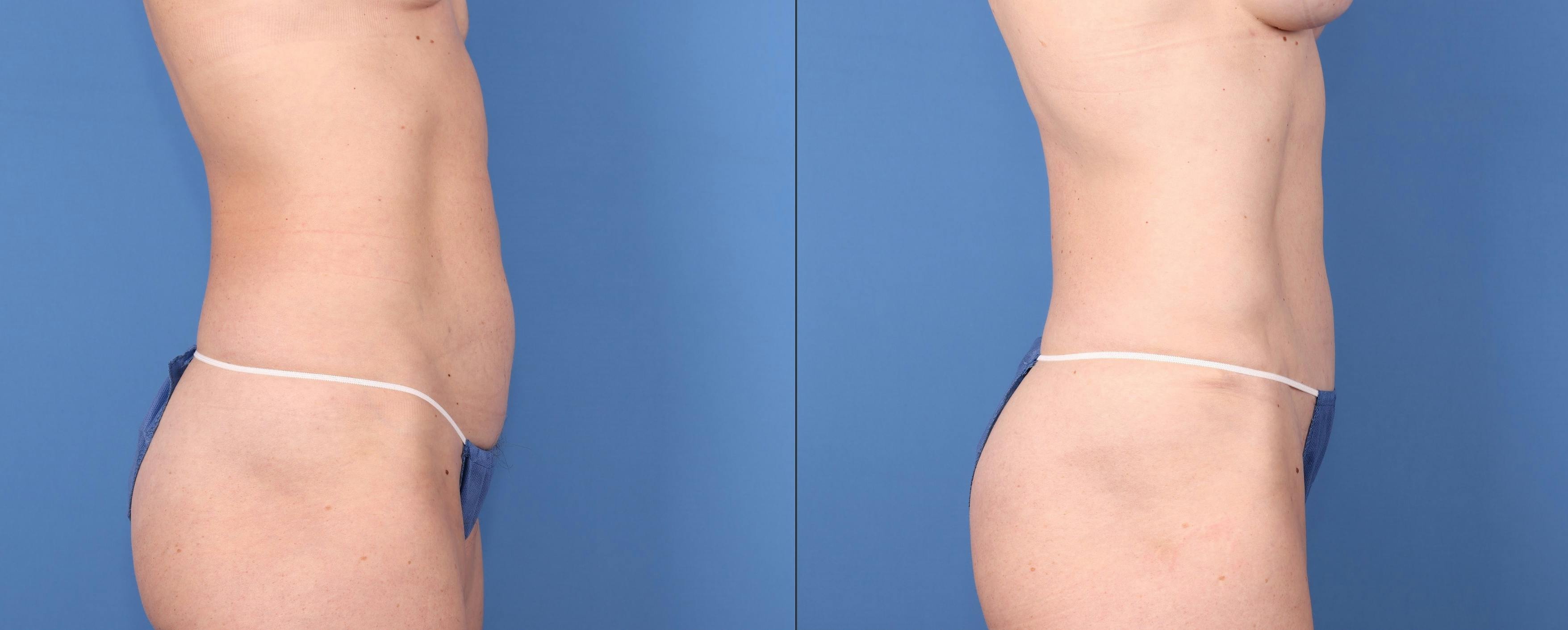 Abdomen Before & After Gallery - Patient 149385204 - Image 3