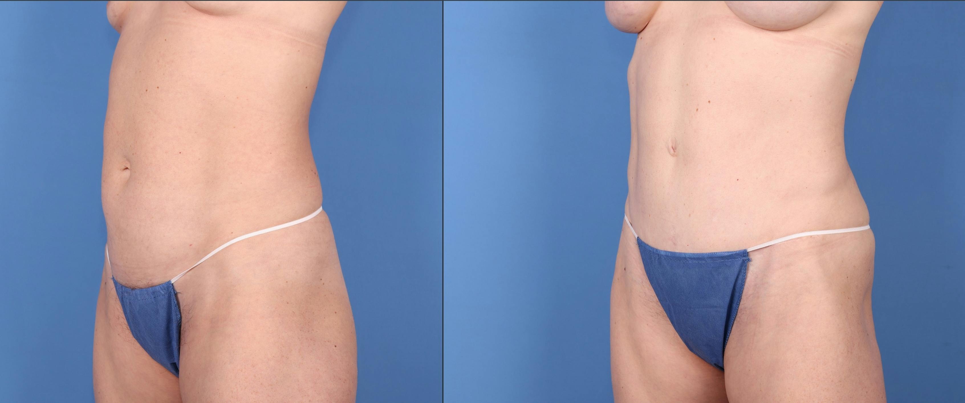 Abdomen Before & After Gallery - Patient 149385204 - Image 4