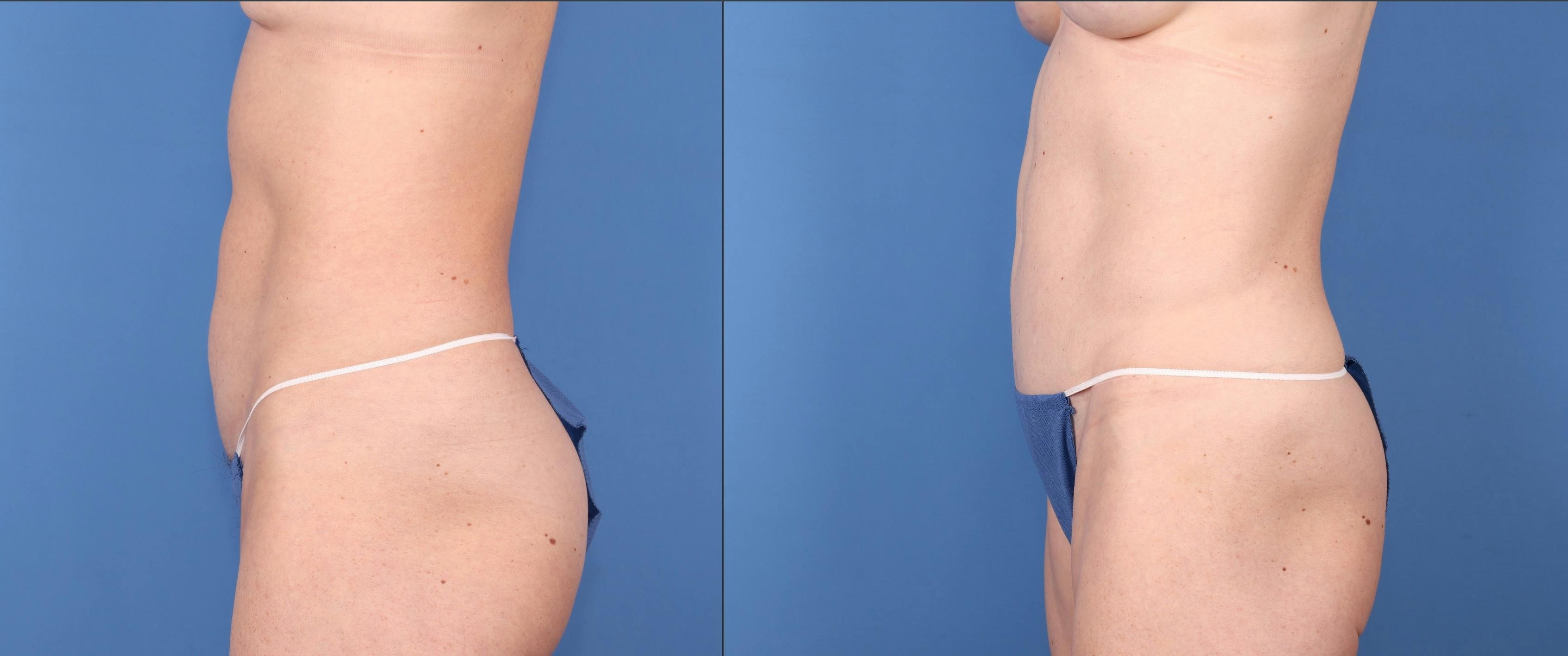 Liposuction Before & After Gallery - Patient 148447966 - Image 5