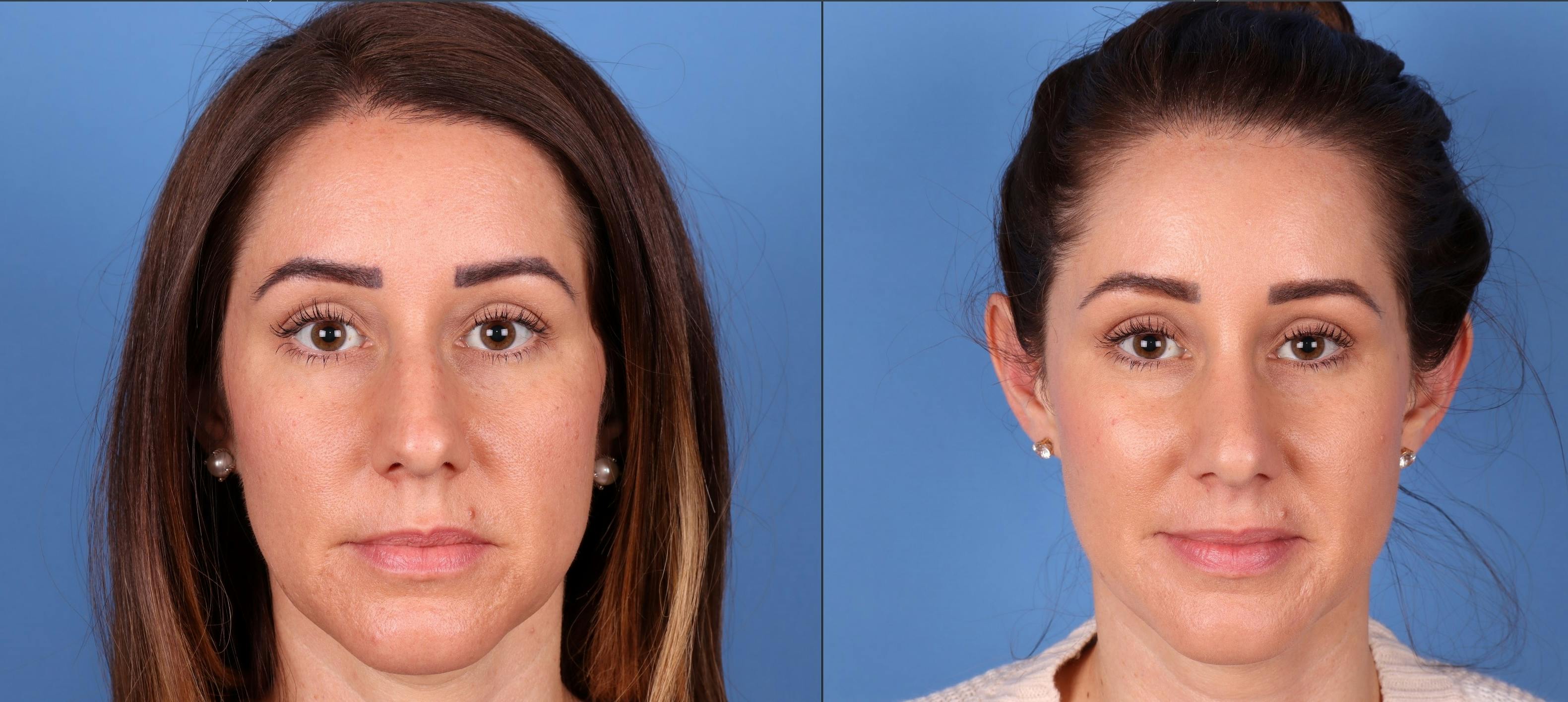 Rhinoplasty Before & After Gallery - Patient 148560718 - Image 3
