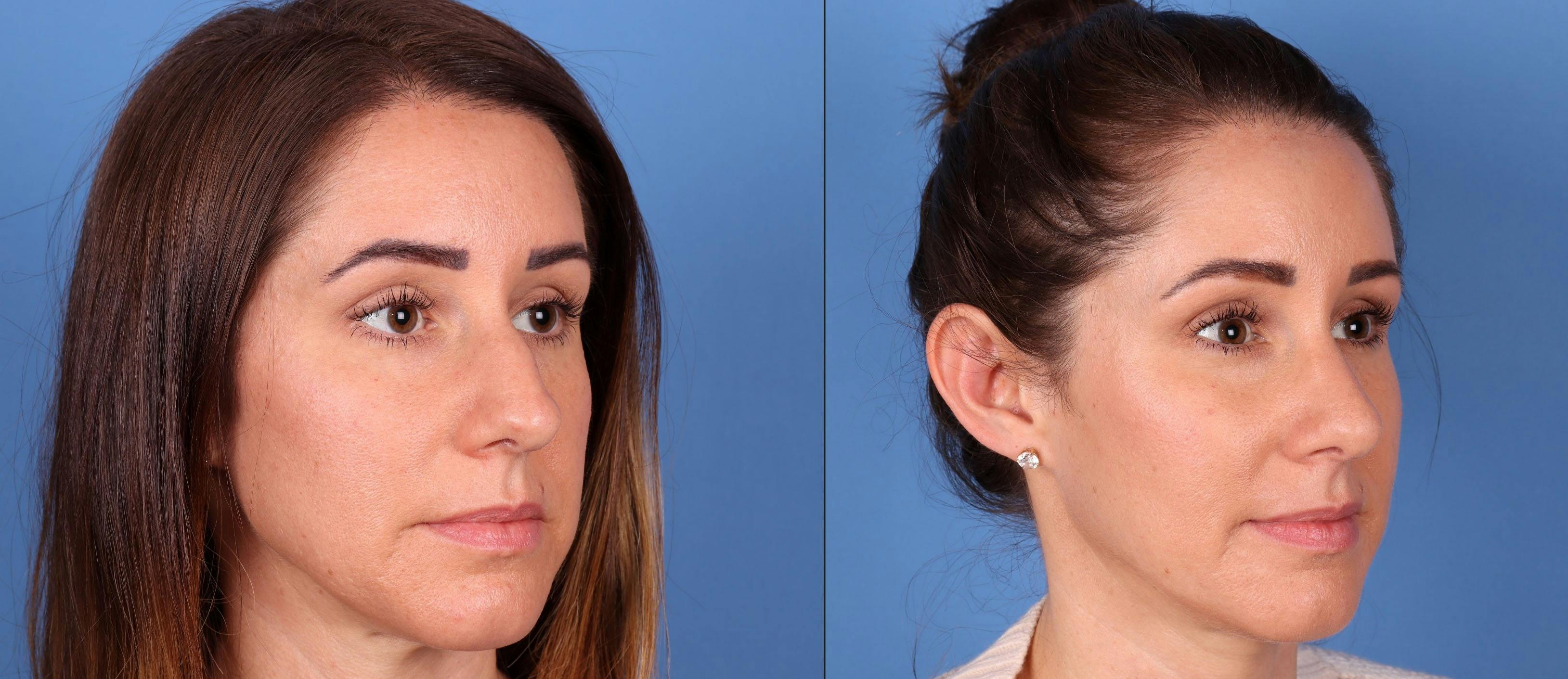 Rhinoplasty Before & After Gallery - Patient 148560718 - Image 2