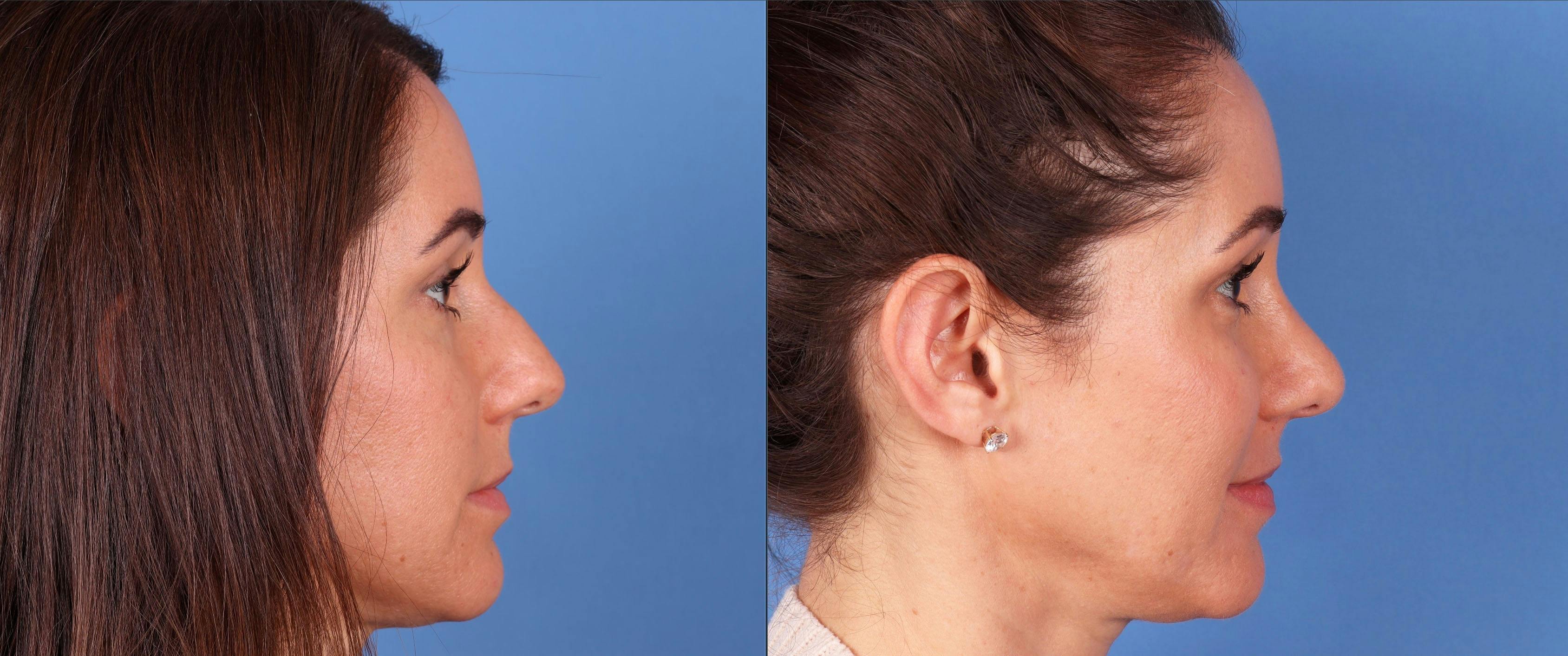 Rhinoplasty Before & After Gallery - Patient 148560718 - Image 1