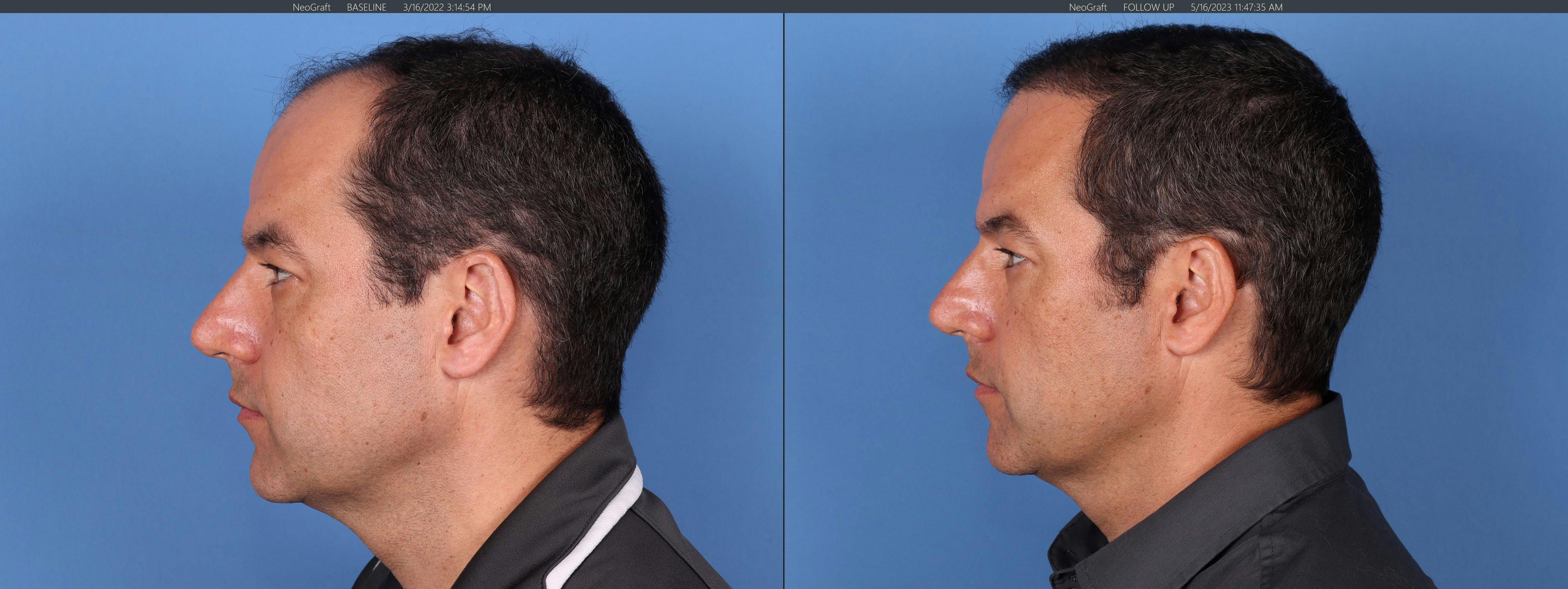 NeoGraft Hair Restoration Before & After Gallery - Patient 148560766 - Image 5