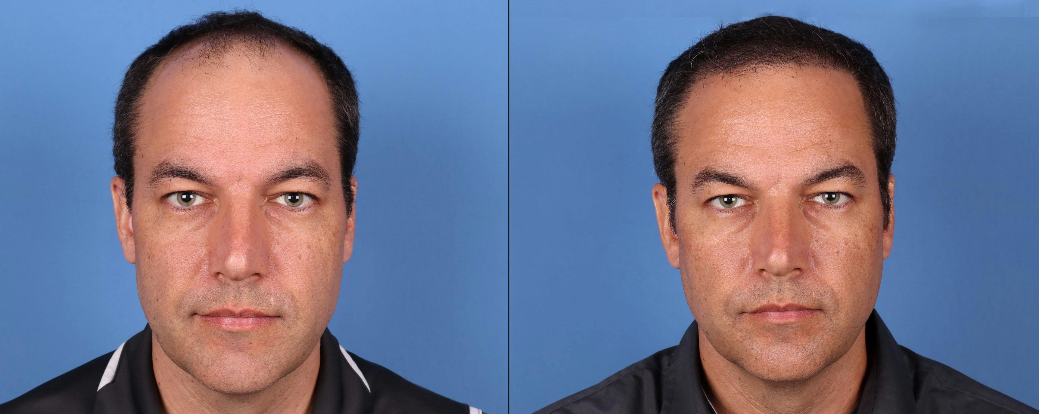 NeoGraft Hair Restoration Before & After Gallery - Patient 148560766 - Image 1