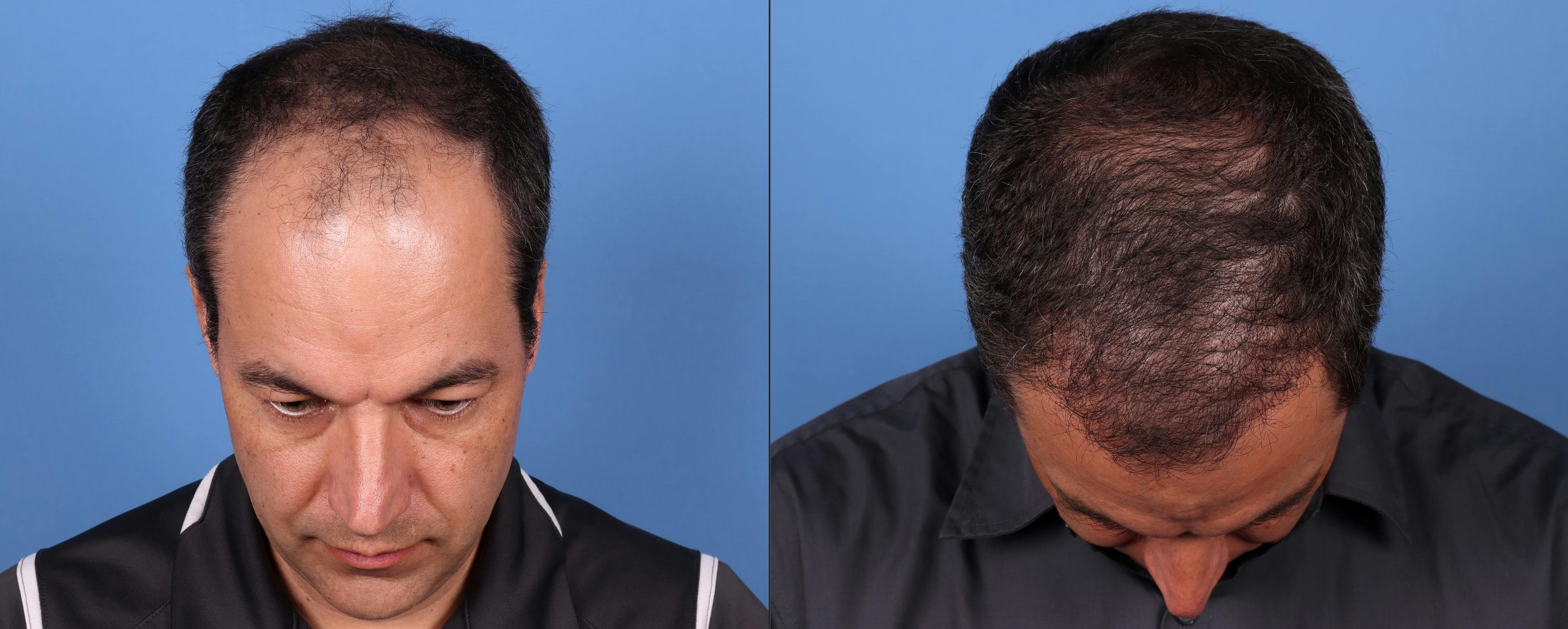 NeoGraft Hair Restoration Before & After Gallery - Patient 148560766 - Image 2