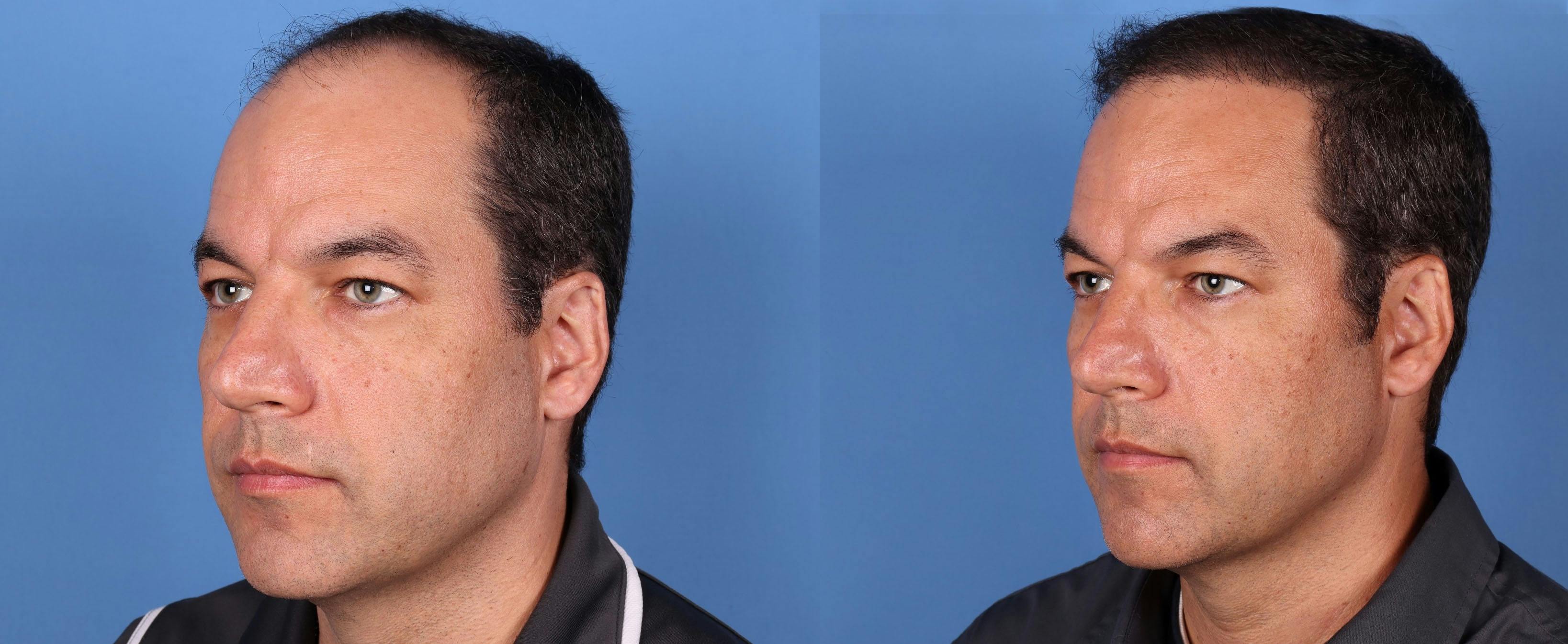 NeoGraft Hair Restoration Before & After Gallery - Patient 148560766 - Image 4