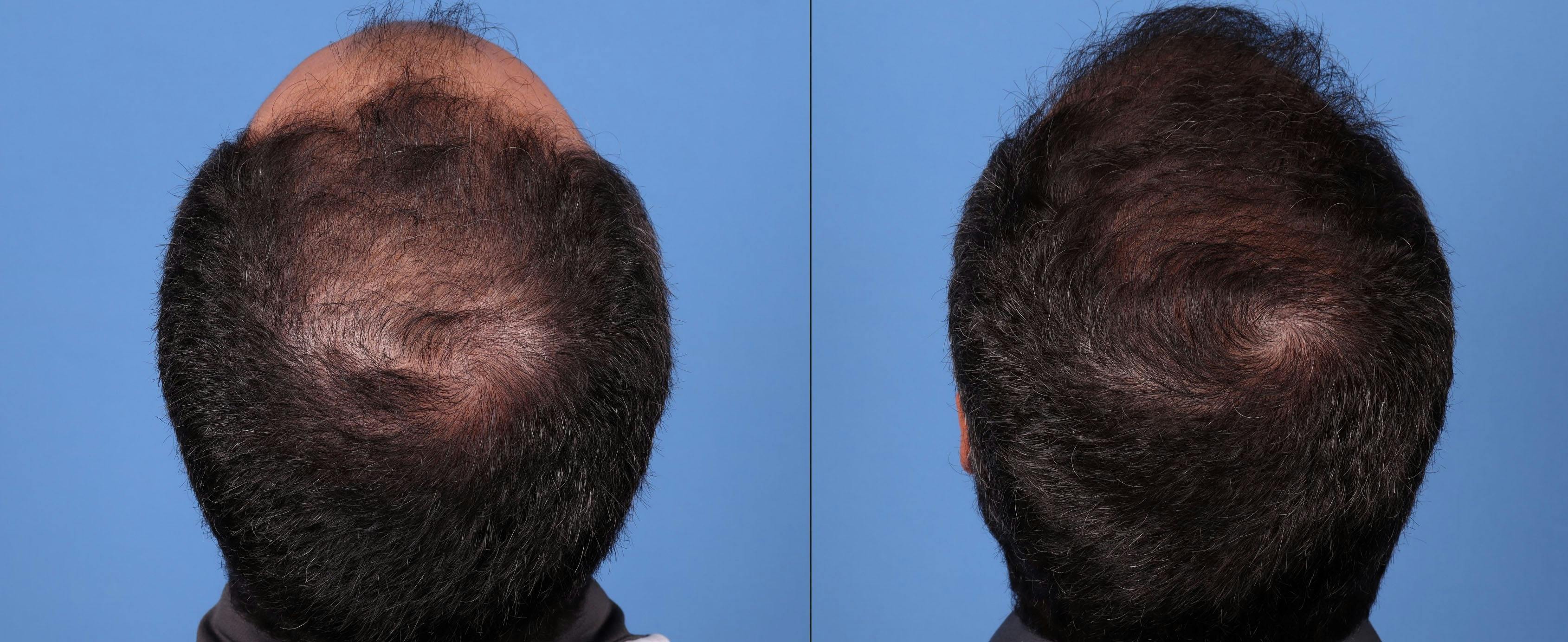 NeoGraft Hair Restoration Before & After Gallery - Patient 148560766 - Image 3