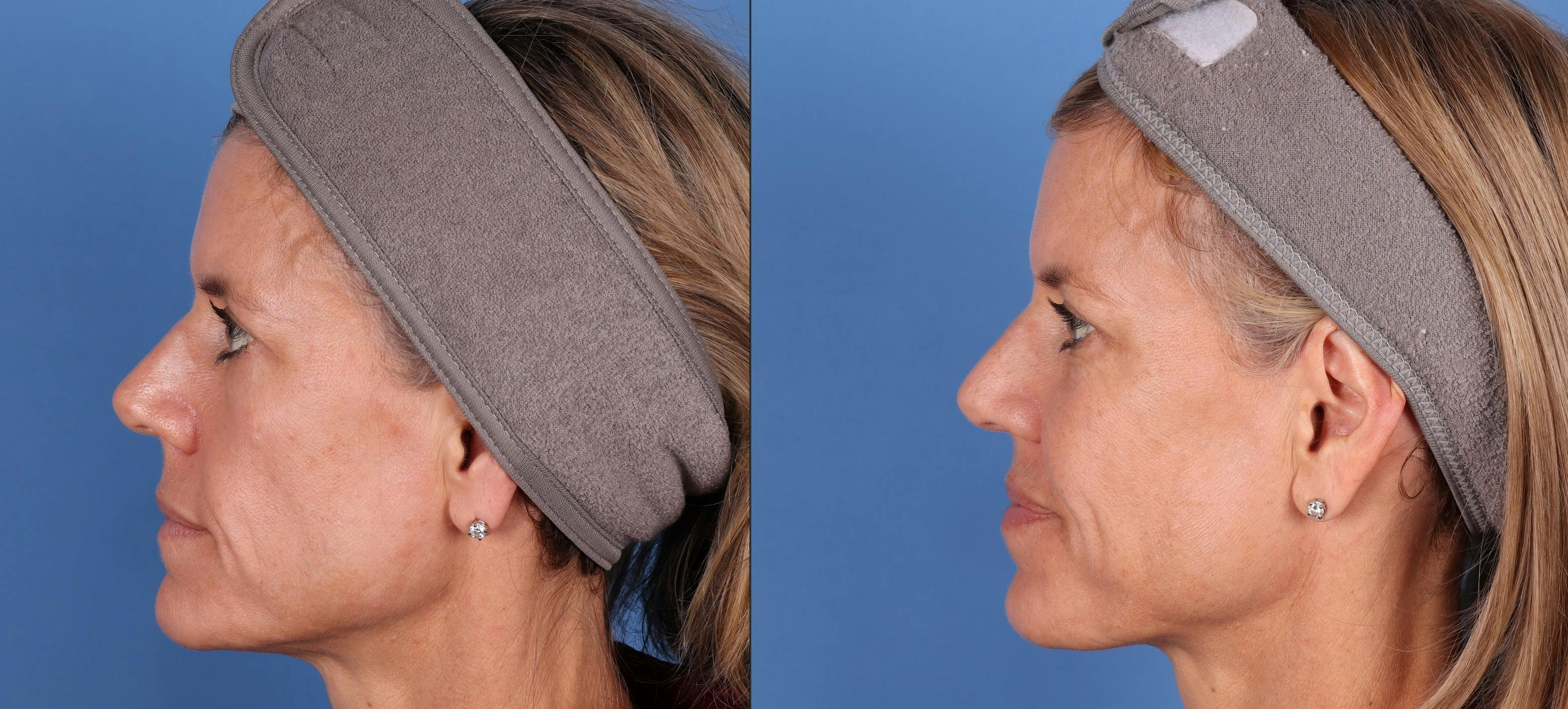 Facial Fillers Before & After Gallery - Patient 148703592 - Image 3