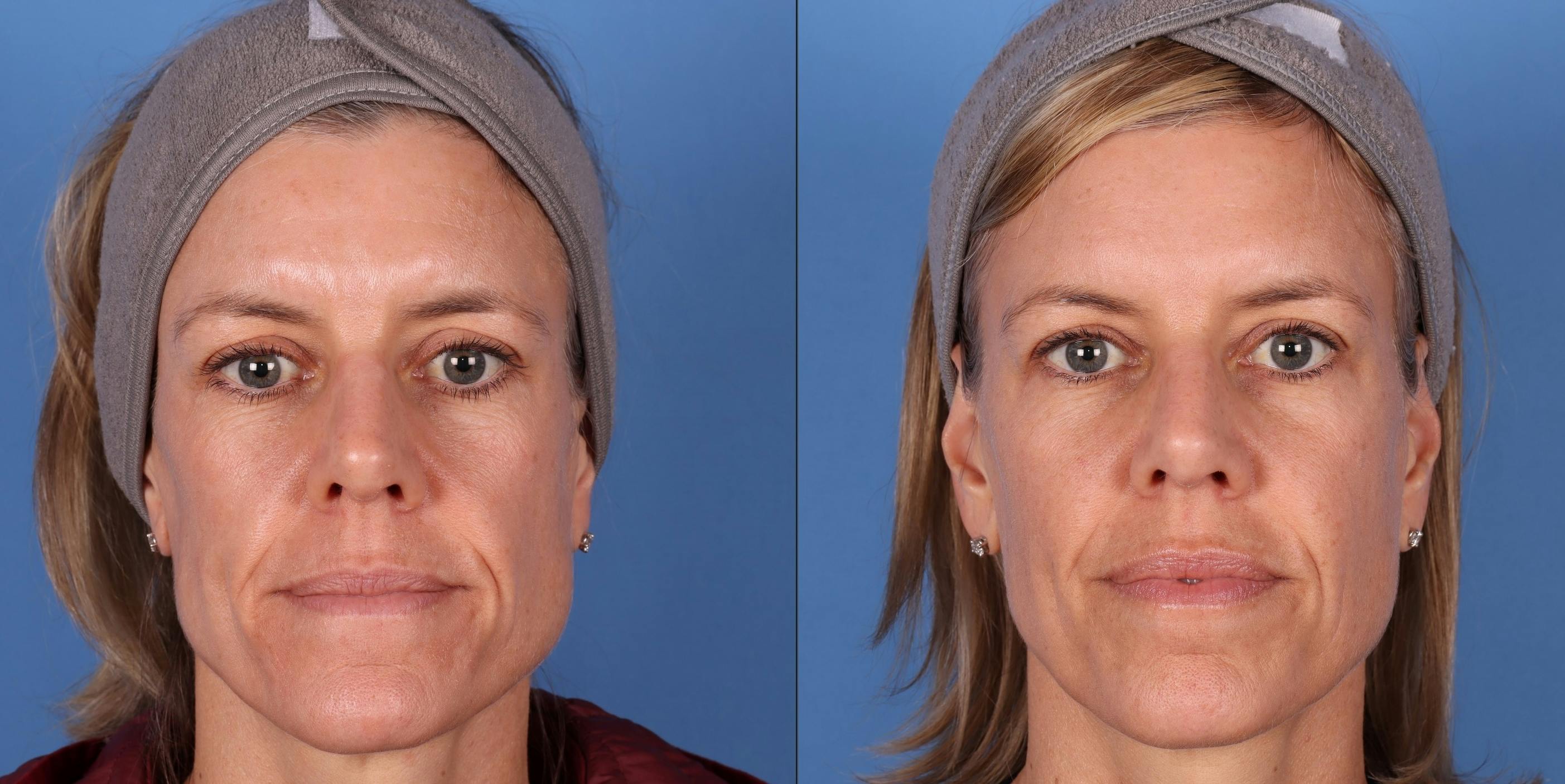 Facial Fillers Before & After Gallery - Patient 148703592 - Image 1