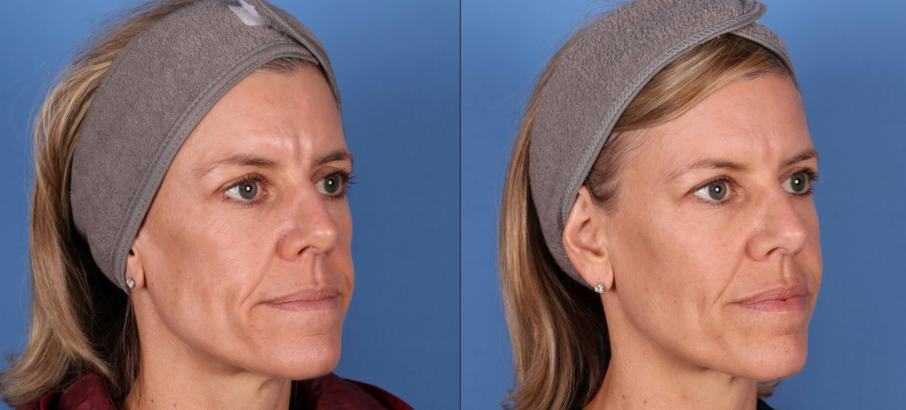 Facial Fillers Before & After Gallery - Patient 148703592 - Image 4