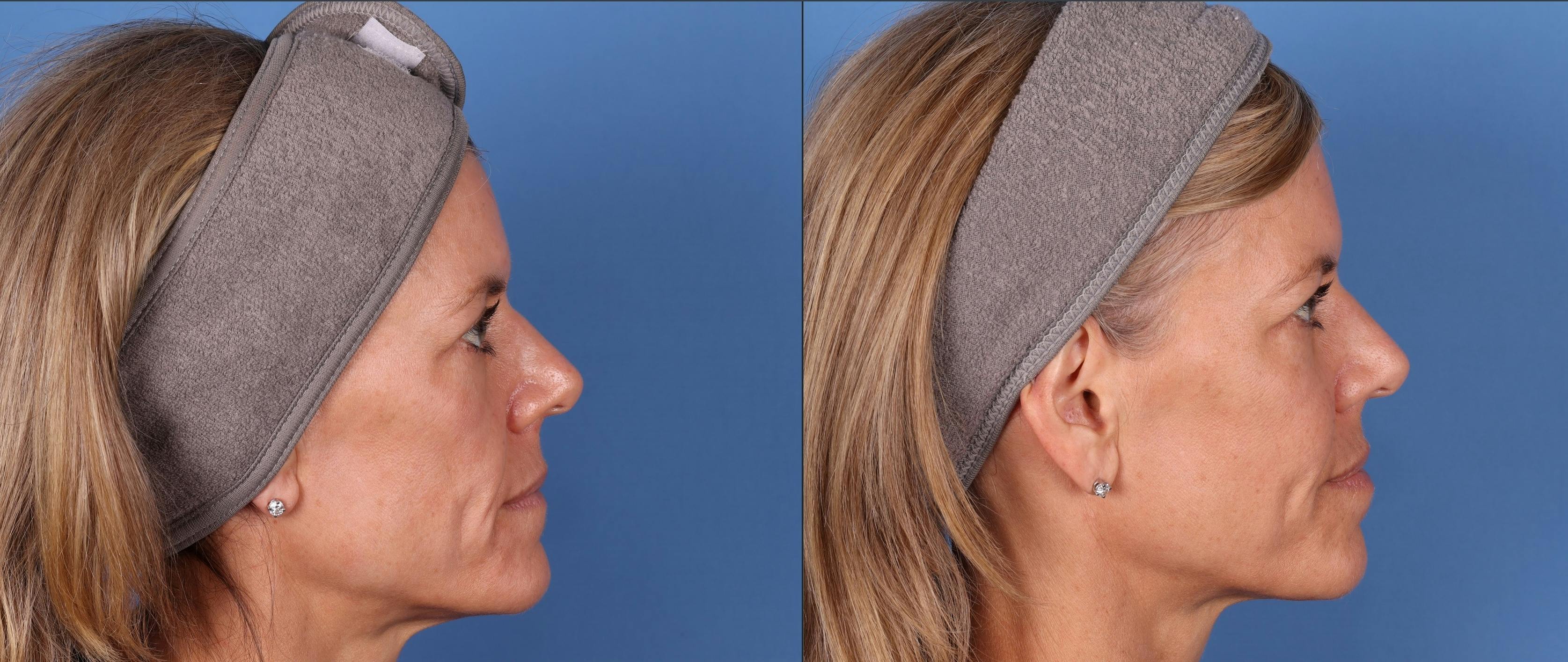 Facial Fillers Before & After Gallery - Patient 148703592 - Image 5