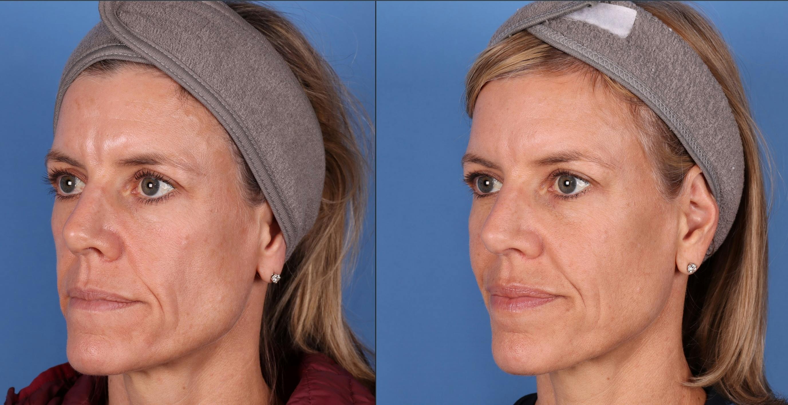 Facial Fillers Before & After Gallery - Patient 148703592 - Image 2