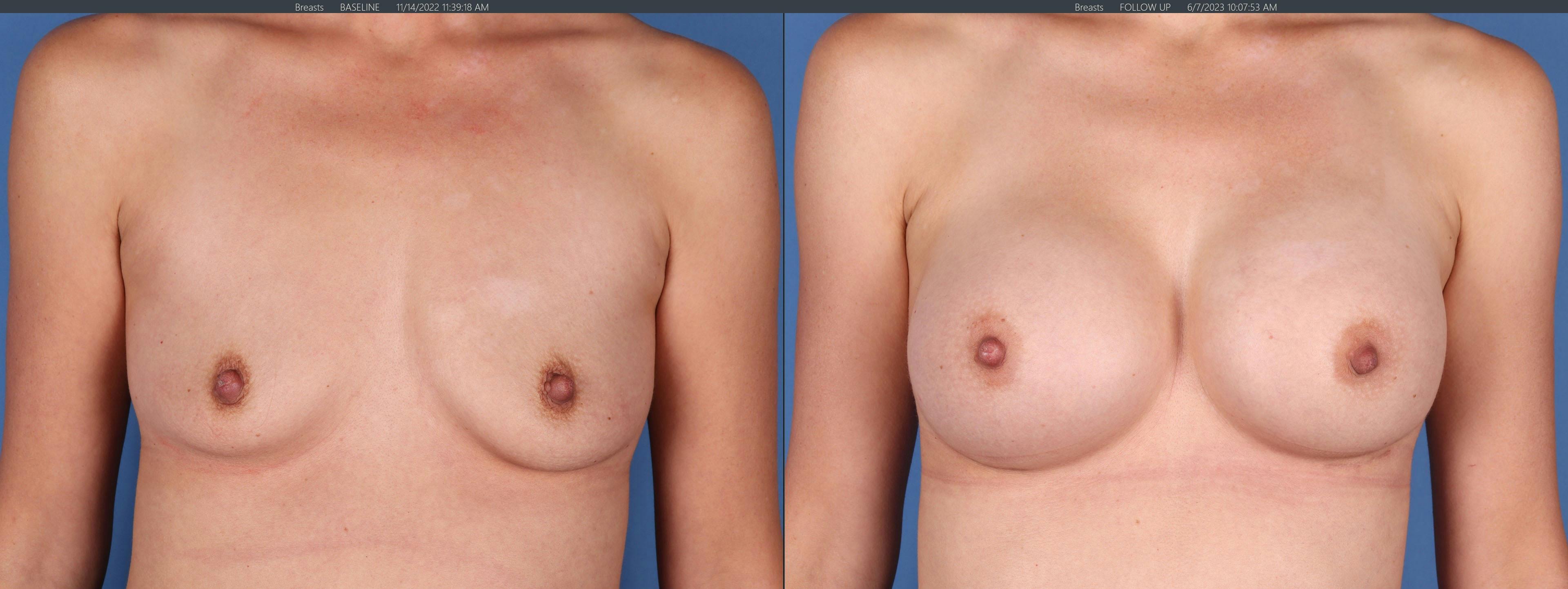 Breast Augmentation Before & After Gallery - Patient 149031946 - Image 1