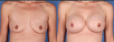 Breast Augmentation Before & After Gallery - Patient 149031946 - Image 1