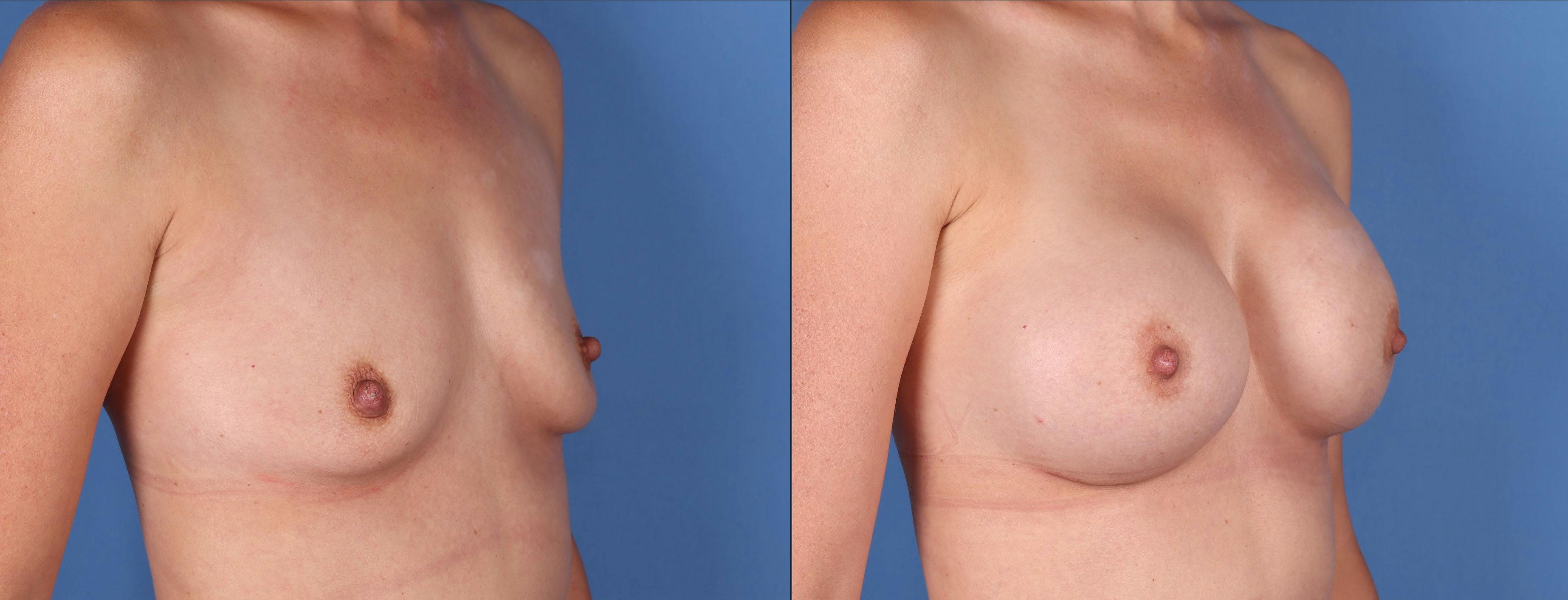 Breast Augmentation Before & After Gallery - Patient 149031946 - Image 2
