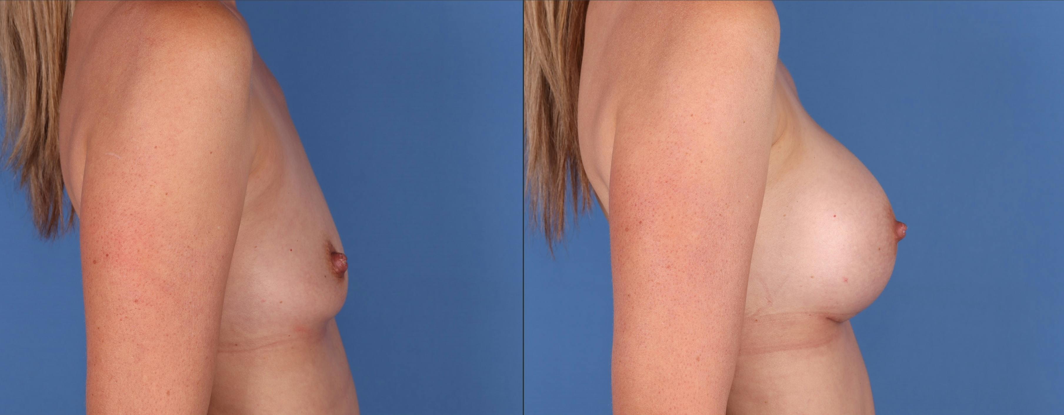 Breast Augmentation Before & After Gallery - Patient 149031946 - Image 3