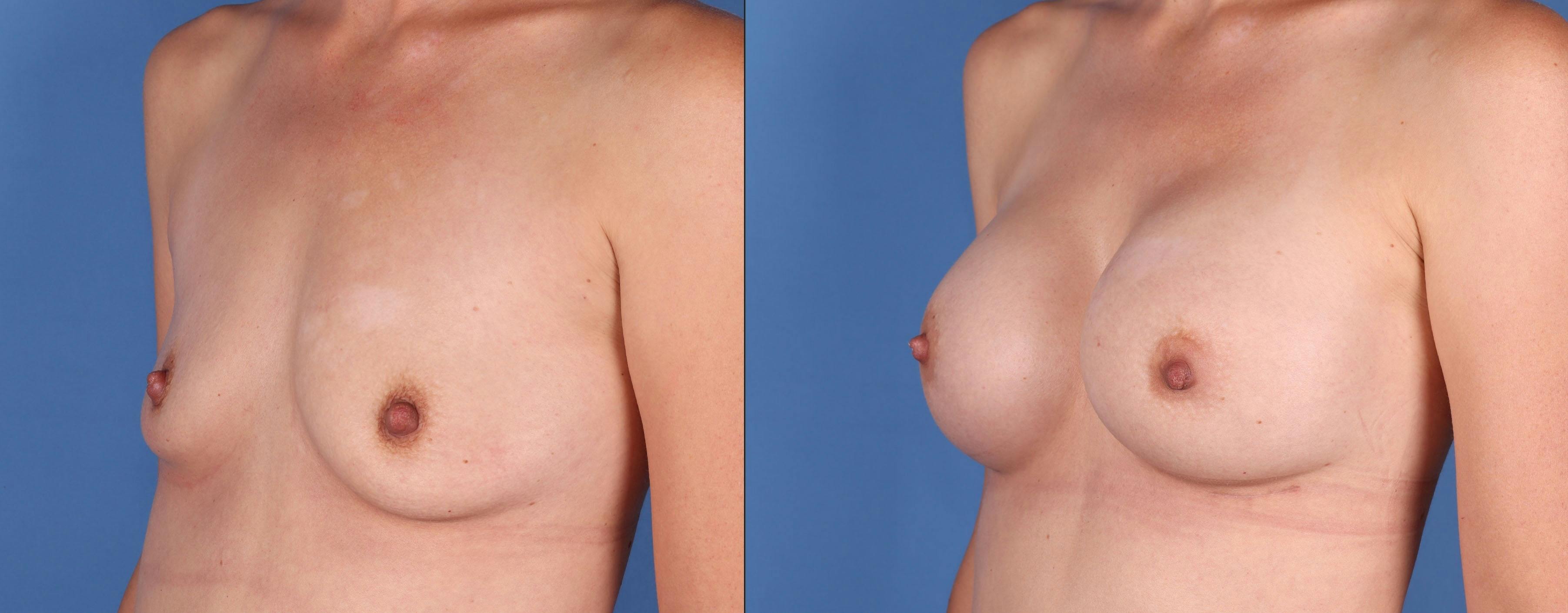 Breast Augmentation Before & After Gallery - Patient 149031946 - Image 4