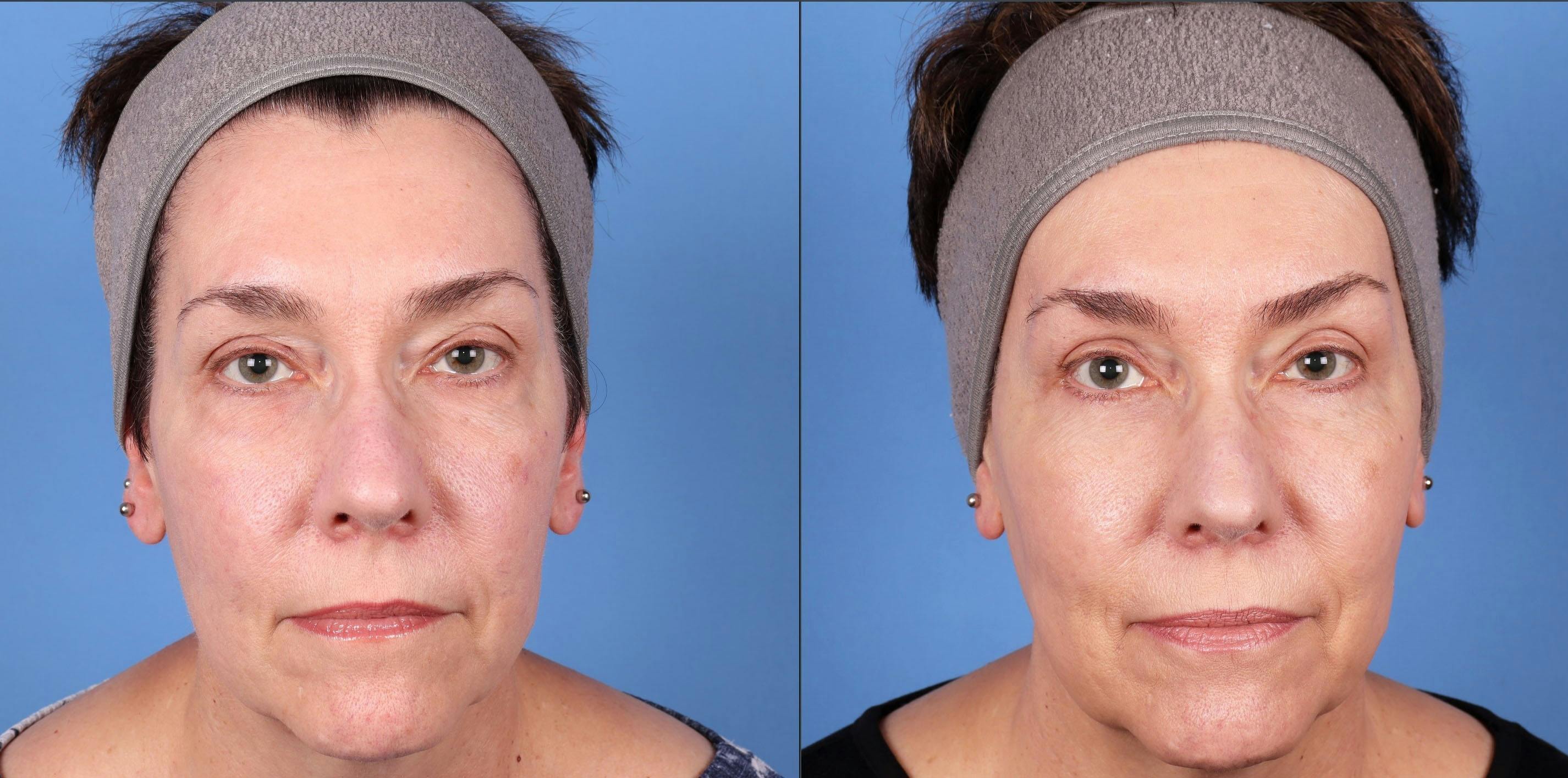Eyelid Surgery (Upper & Lower Blepharoplasty) Before & After Gallery - Patient 997203 - Image 1