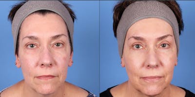 Eyelid Surgery (Upper & Lower Blepharoplasty) Before & After Gallery - Patient 997203 - Image 1