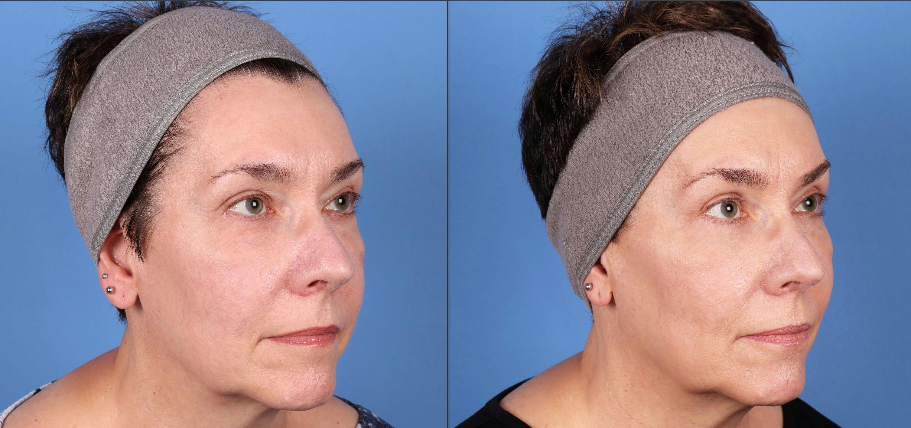 Eyelid Surgery (Blepharoplasty) Before & After Gallery - Patient 149119568 - Image 2