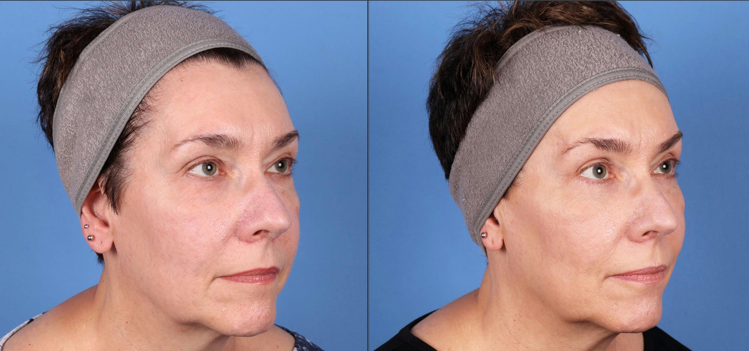 Eyelid Surgery (Upper & Lower Blepharoplasty) Before & After Gallery - Patient 997203 - Image 2