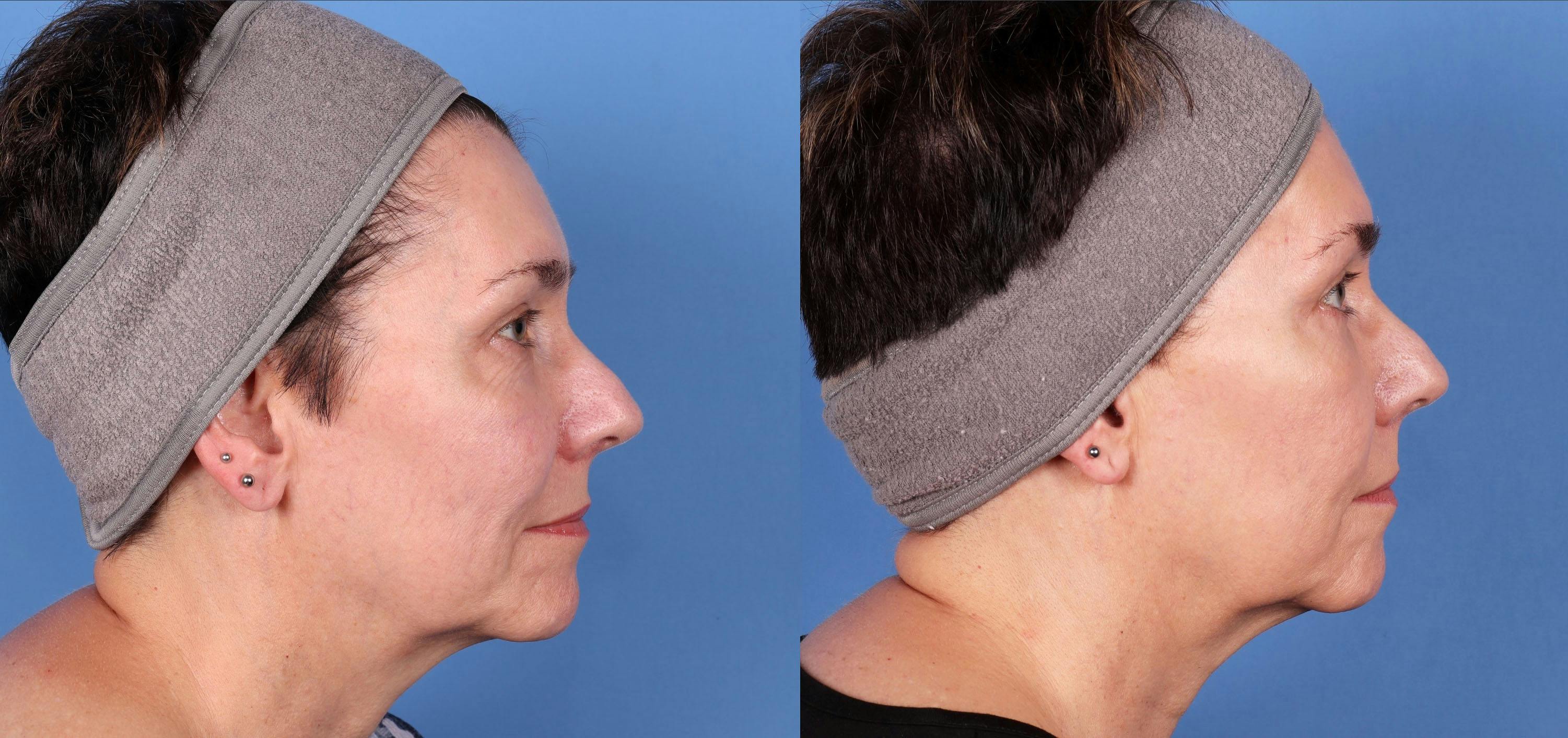 Eyelid Surgery (Upper & Lower Blepharoplasty) Before & After Gallery - Patient 997203 - Image 3