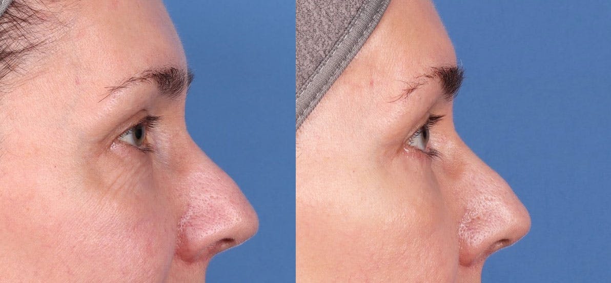 Eyelid Surgery (Blepharoplasty) Before & After Gallery - Patient 149119568 - Image 4