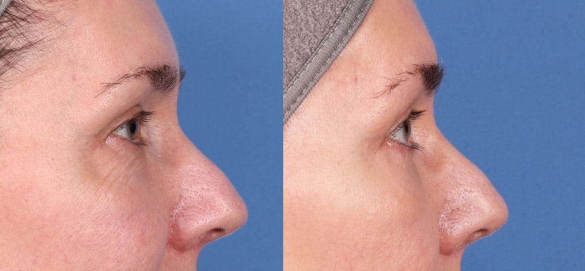 Eyelid Surgery (Upper & Lower Blepharoplasty) Before & After Gallery - Patient 997203 - Image 4