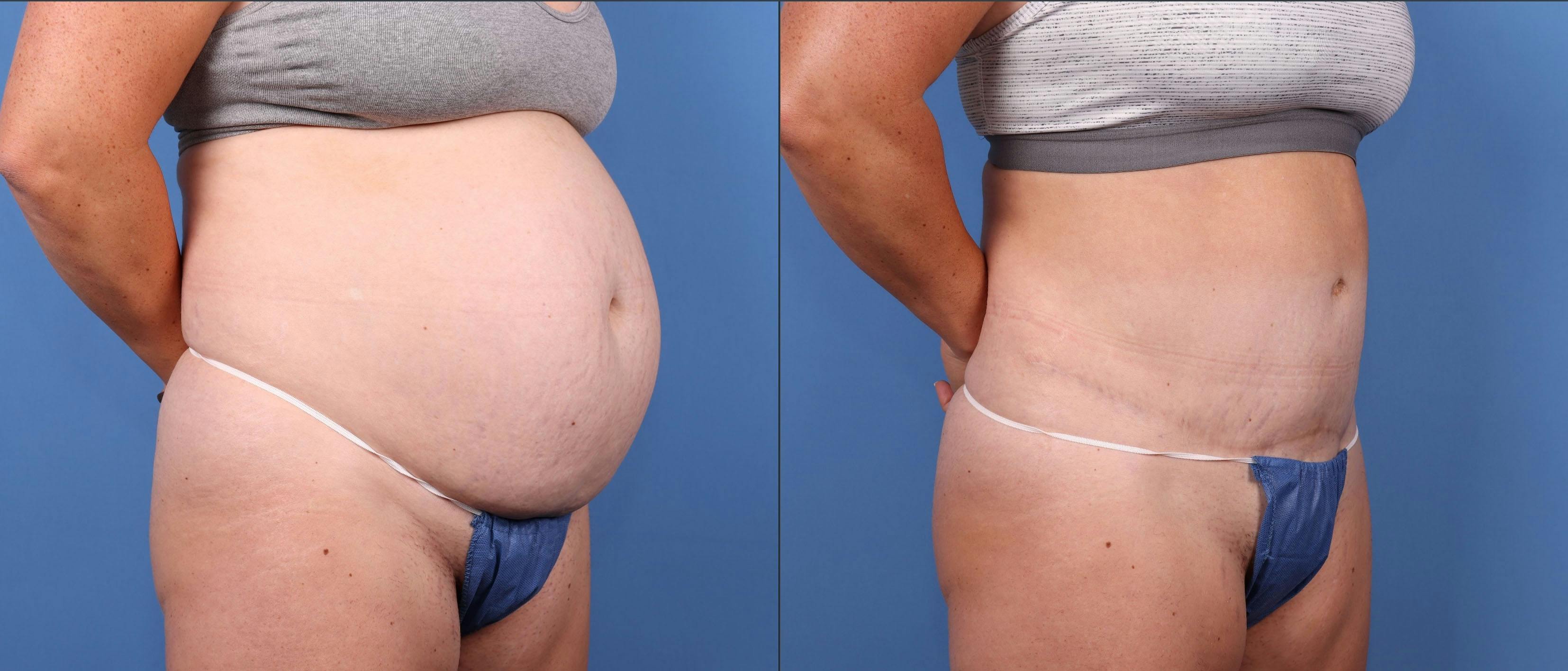 Abdomen Before & After Gallery - Patient 149385203 - Image 2