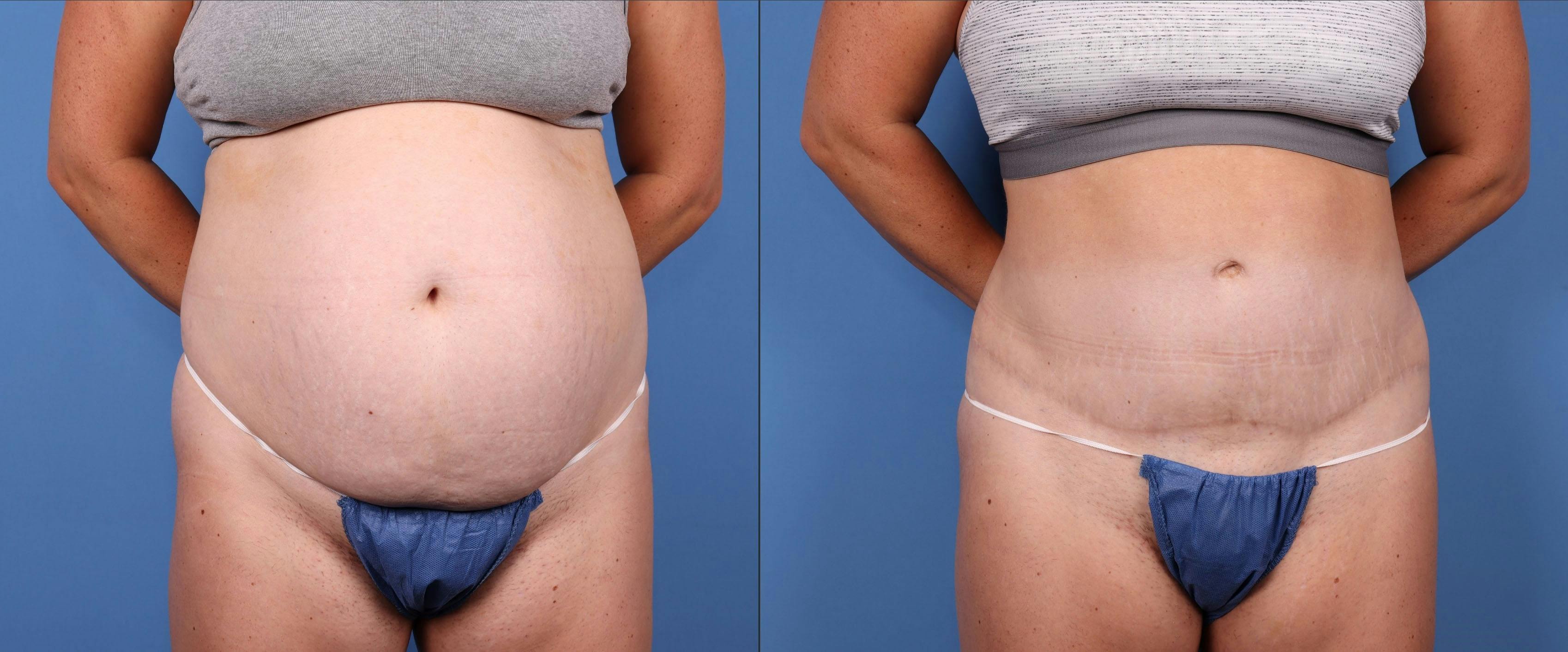 Abdomen Before & After Gallery - Patient 149385203 - Image 1