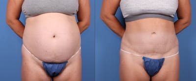 Tummy Tuck Before & After Gallery - Patient 149119658 - Image 1