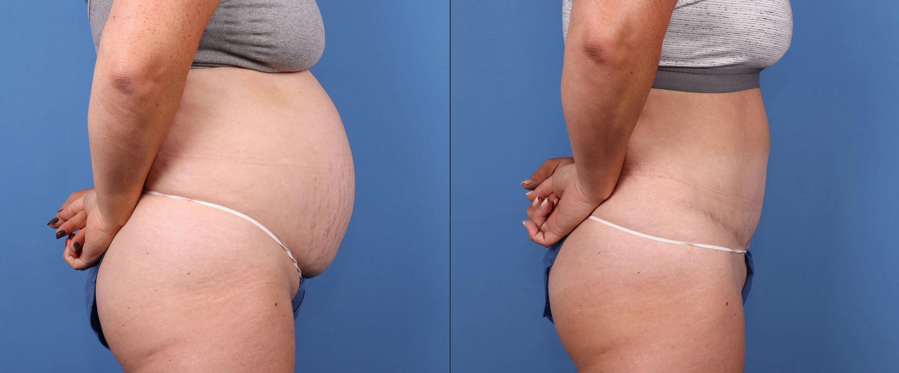 Tummy Tuck Before & After Gallery - Patient 149119658 - Image 3