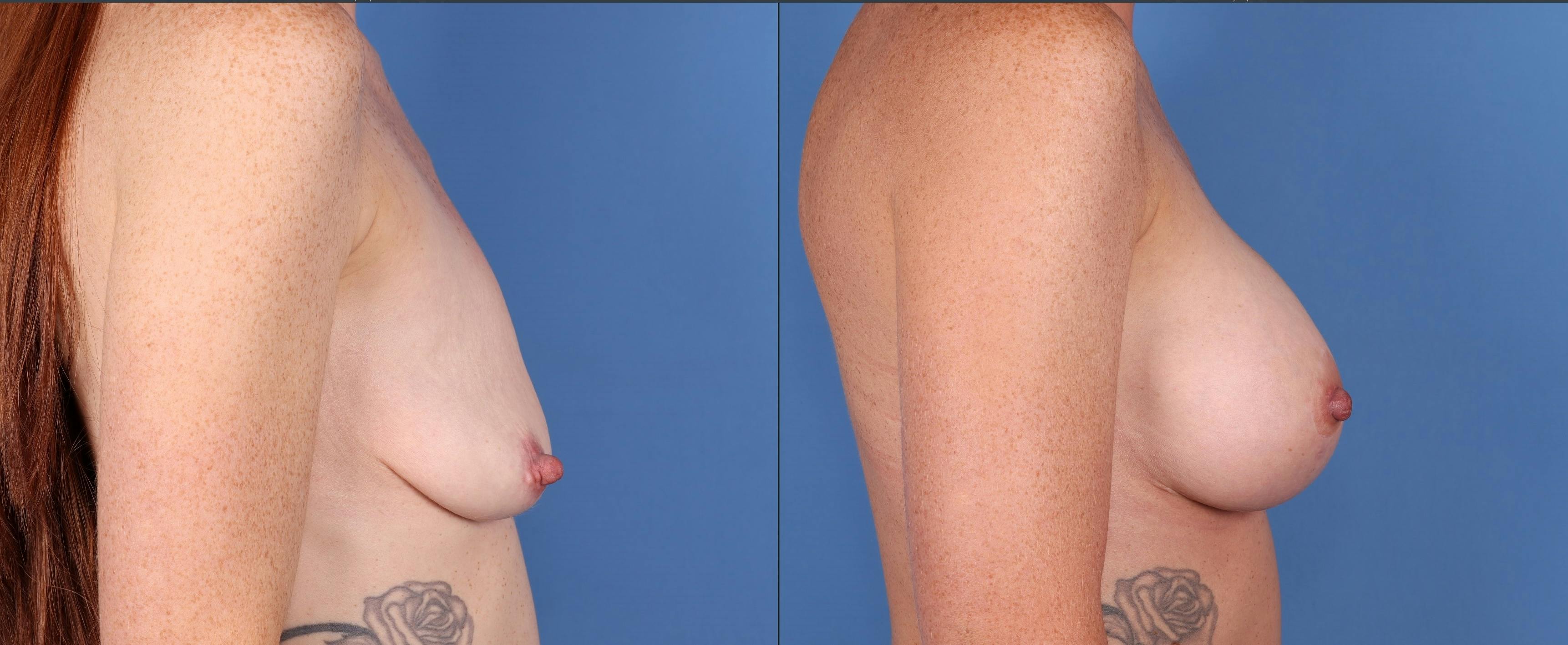 Breast Lift Before & After Gallery - Patient 149119693 - Image 3