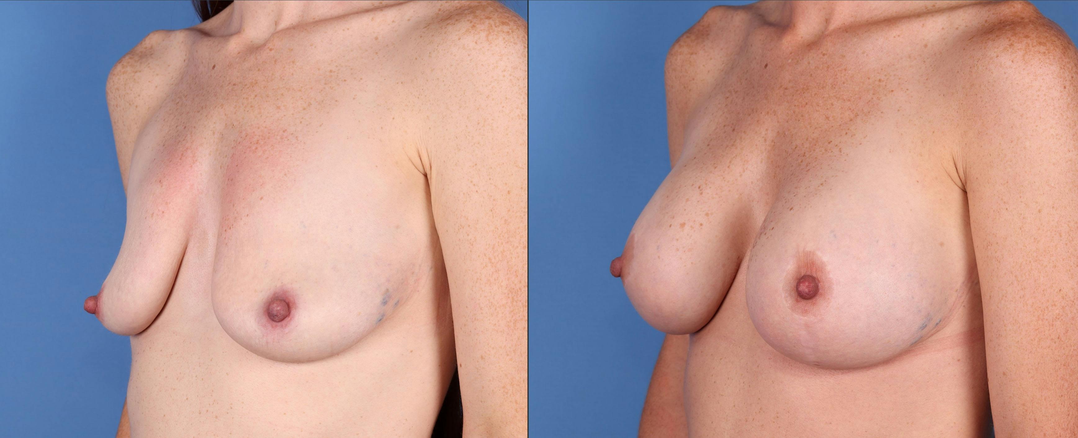 Breast Lift Before & After Gallery - Patient 149119693 - Image 4