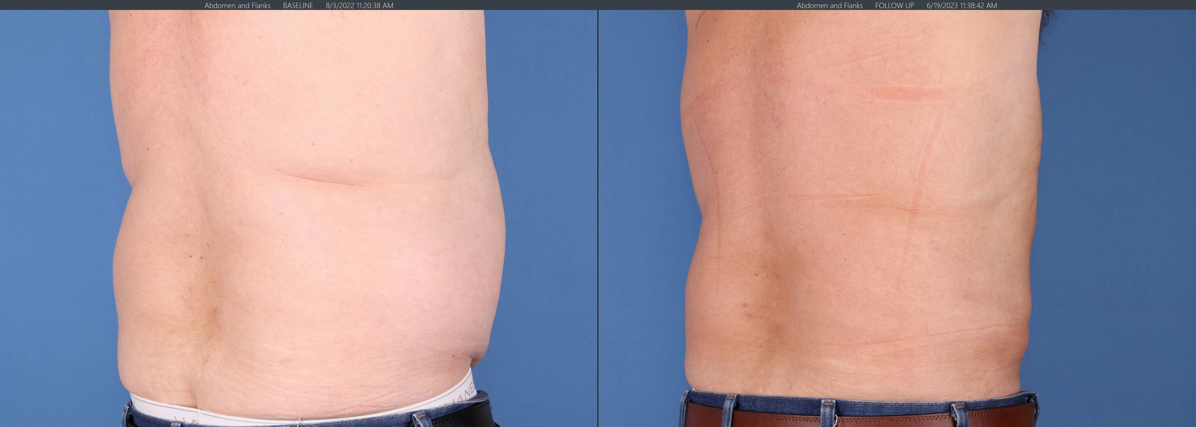 Abdomen Before & After Gallery - Patient 149385202 - Image 4
