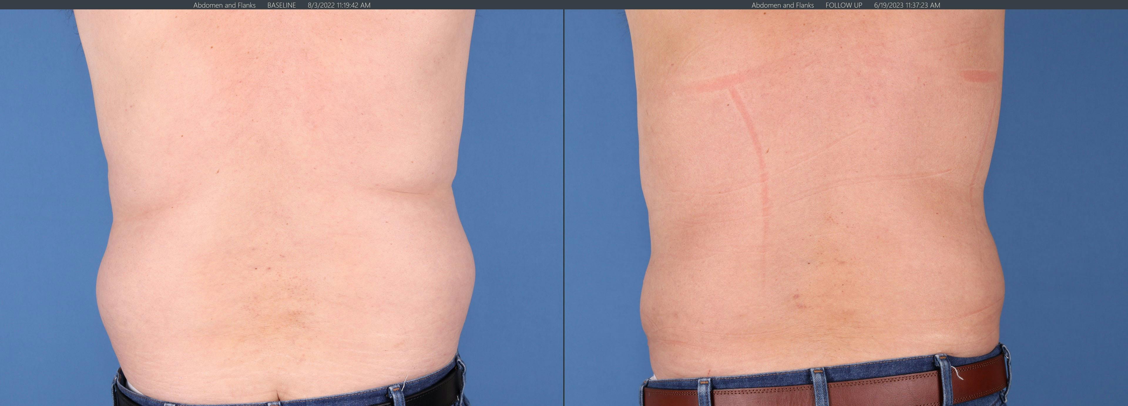Abdomen Before & After Gallery - Patient 149385202 - Image 5