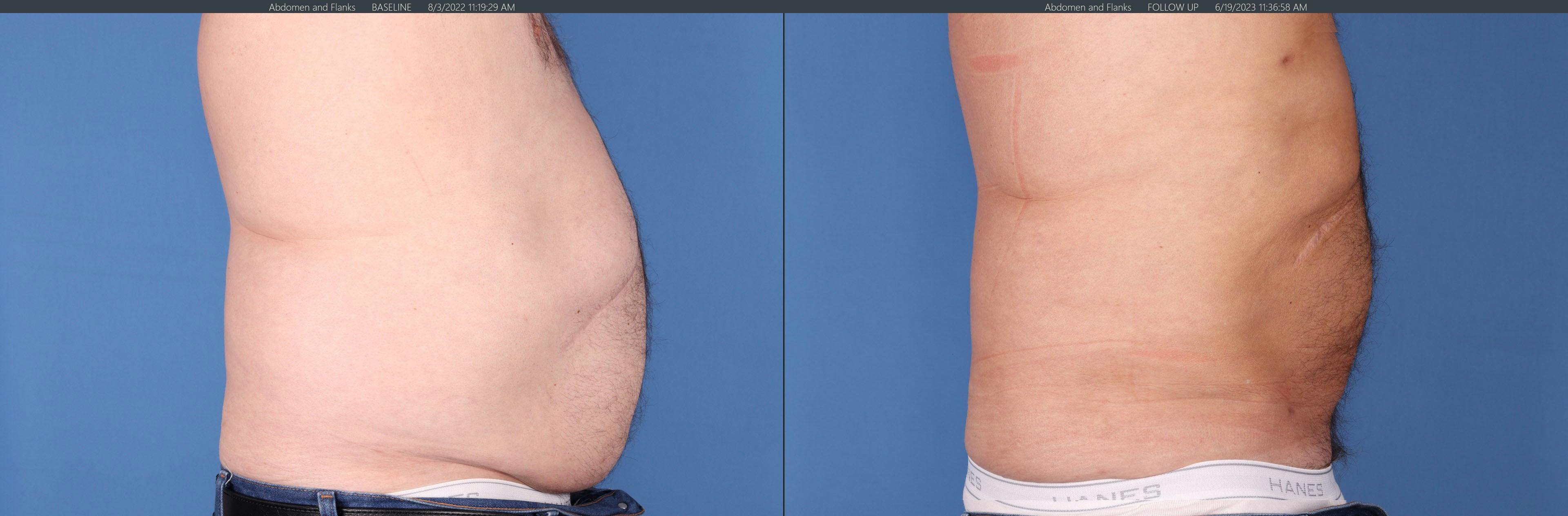 Abdomen Before & After Gallery - Patient 149385202 - Image 3