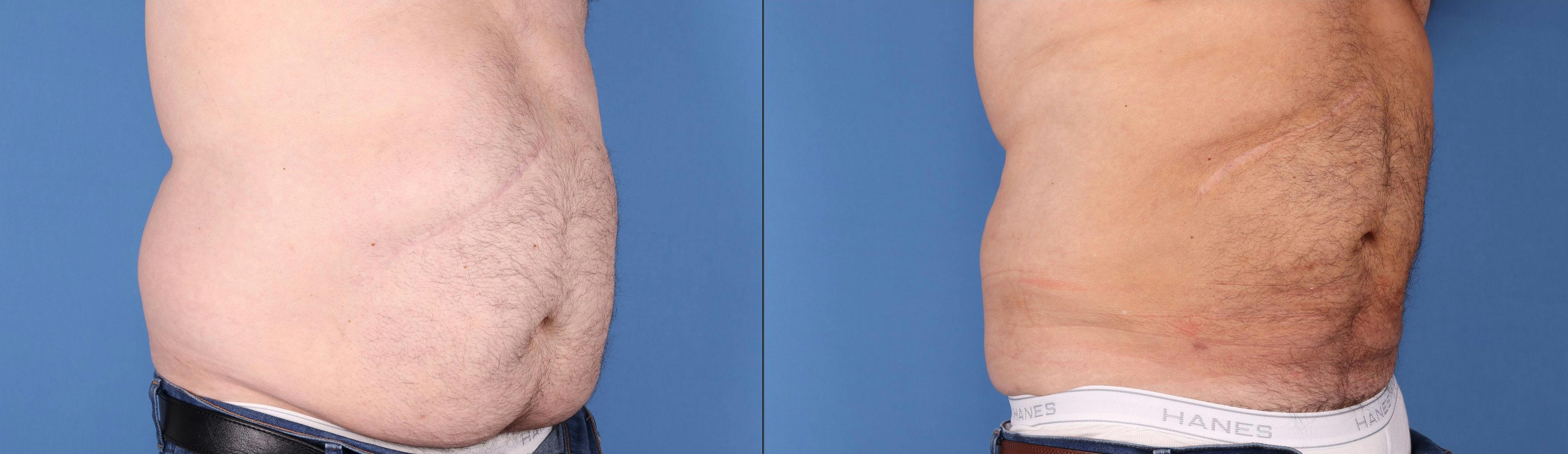 Tummy Tuck Before & After Gallery - Patient 149236567 - Image 2